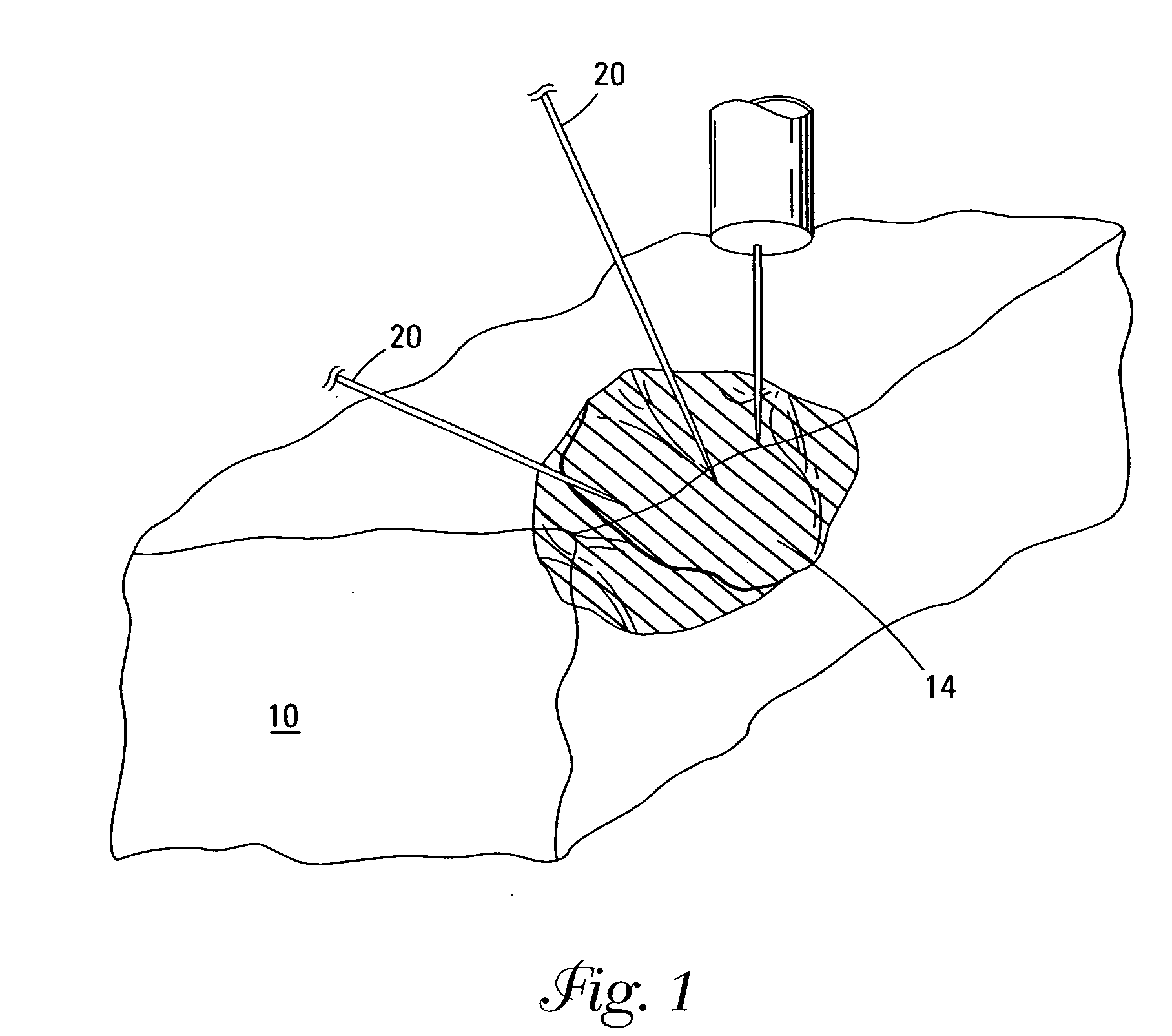 Cryosurgery compositions and methods