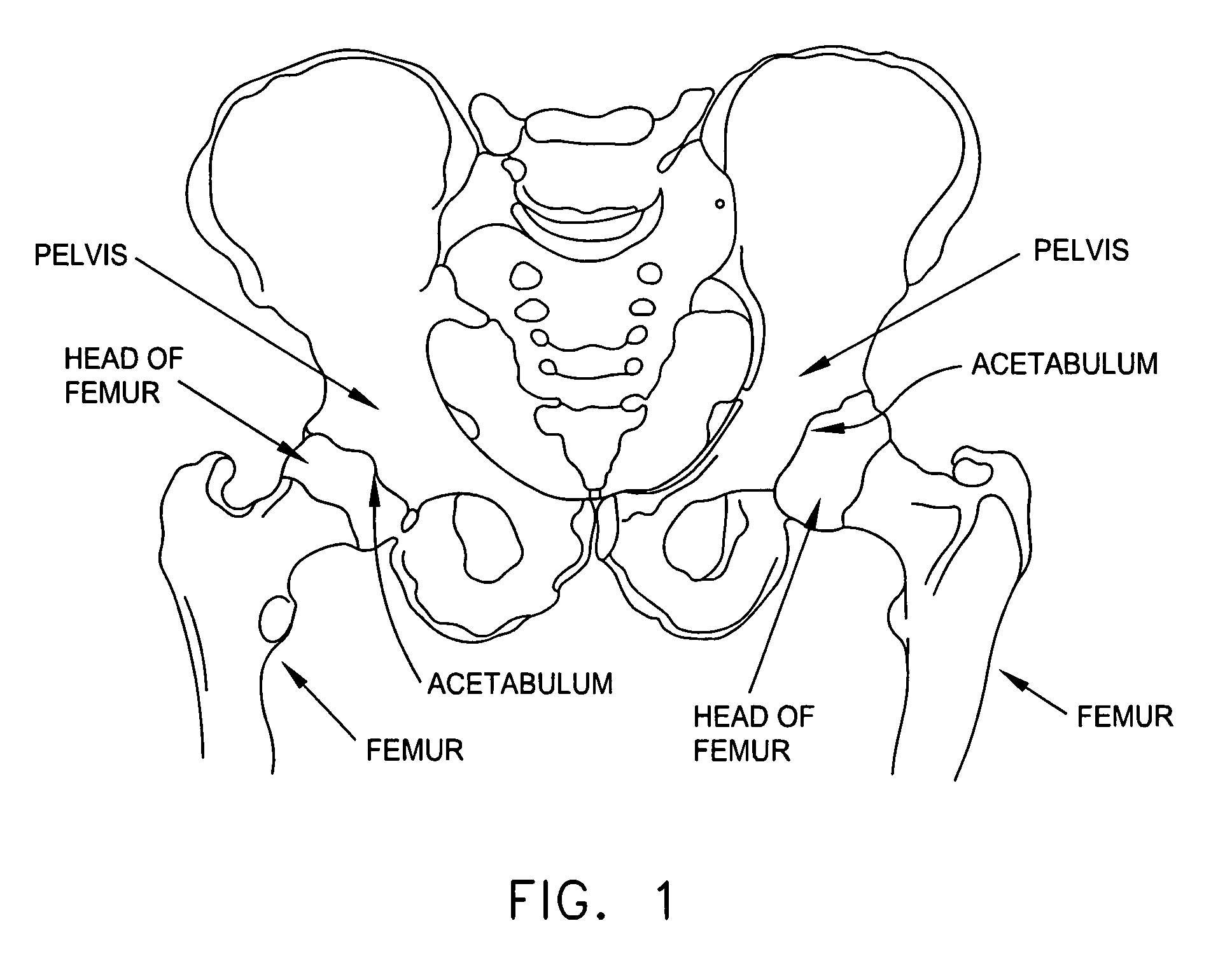 Computer-guided system for orienting the acetabular cup in the pelvis during total hip replacement surgery