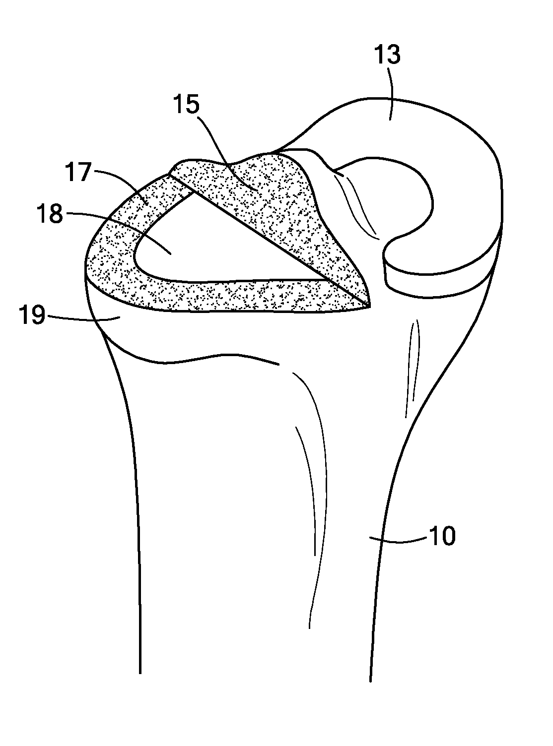 Edge-Matched Articular Implant