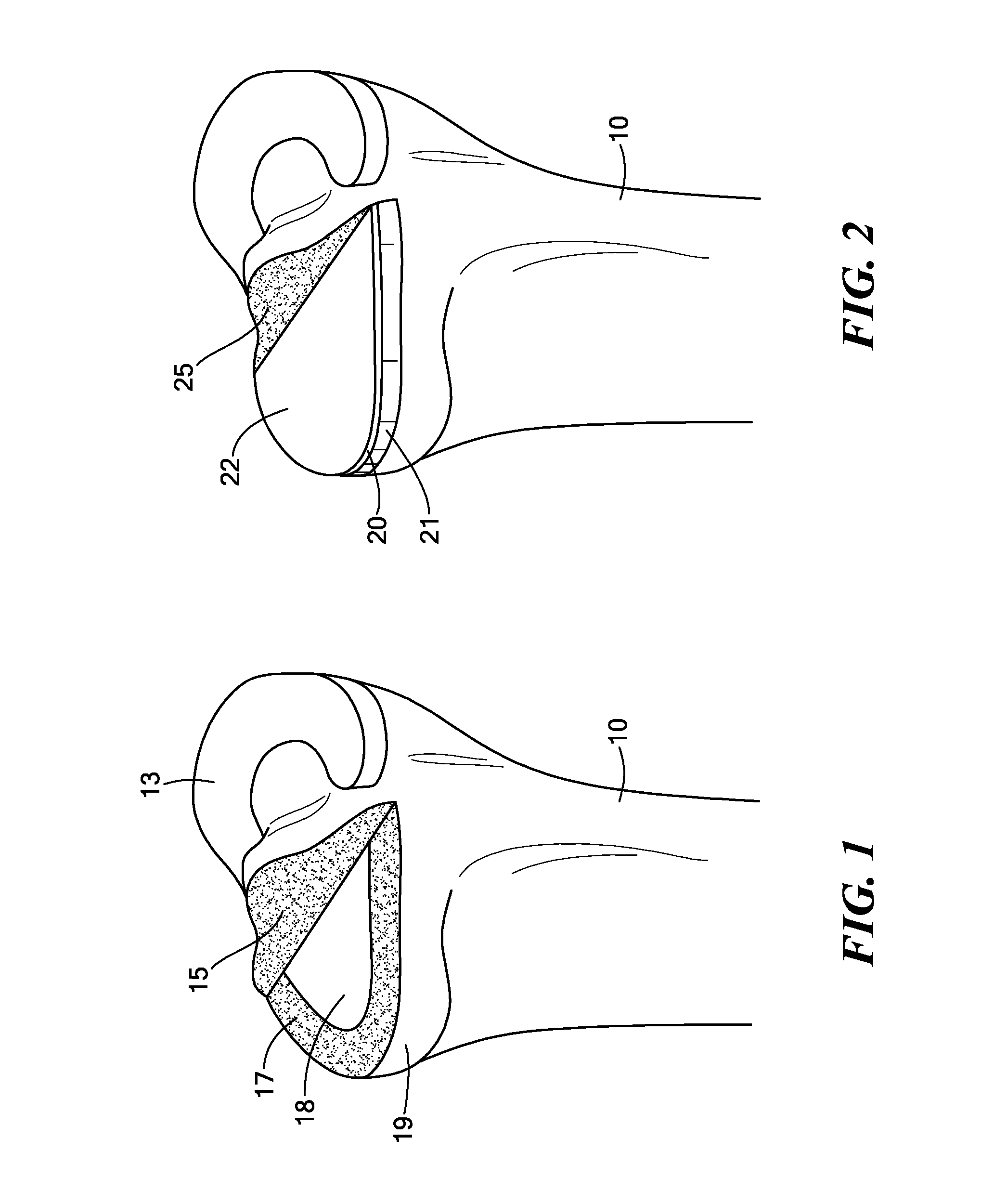 Edge-Matched Articular Implant