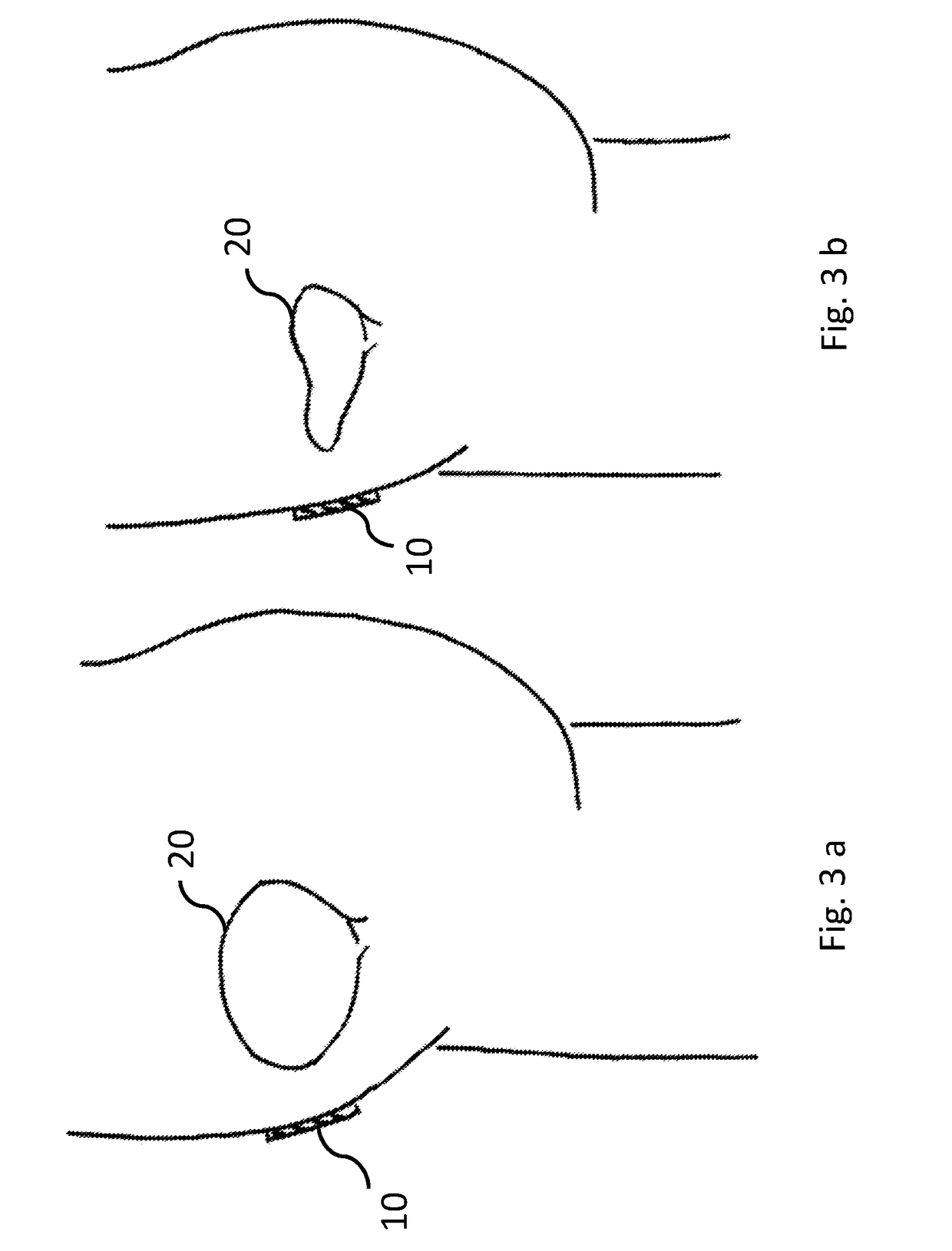 Device for detecting fullness of bladder