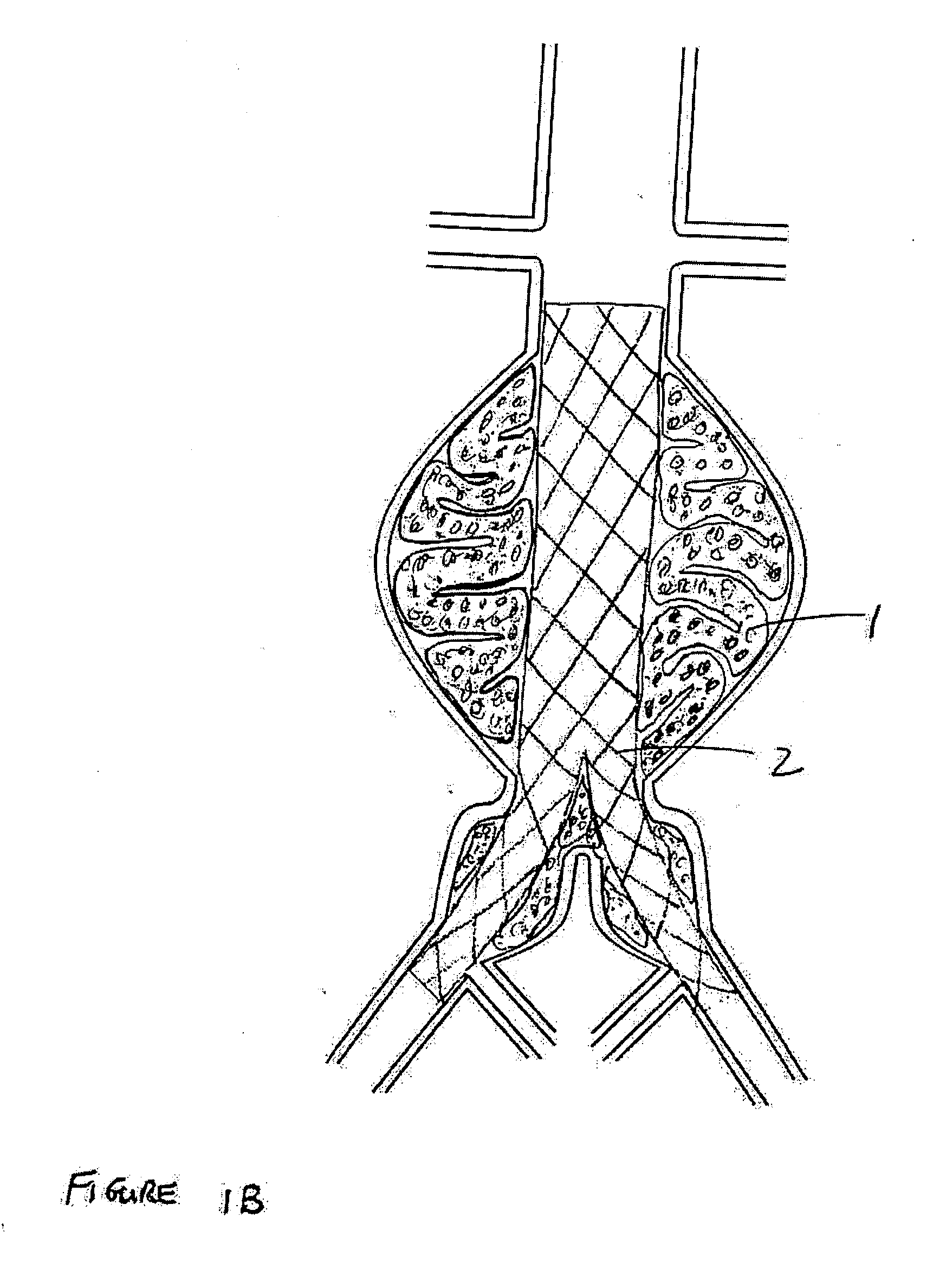 Devices and methods for treatment of vascular aneurysms