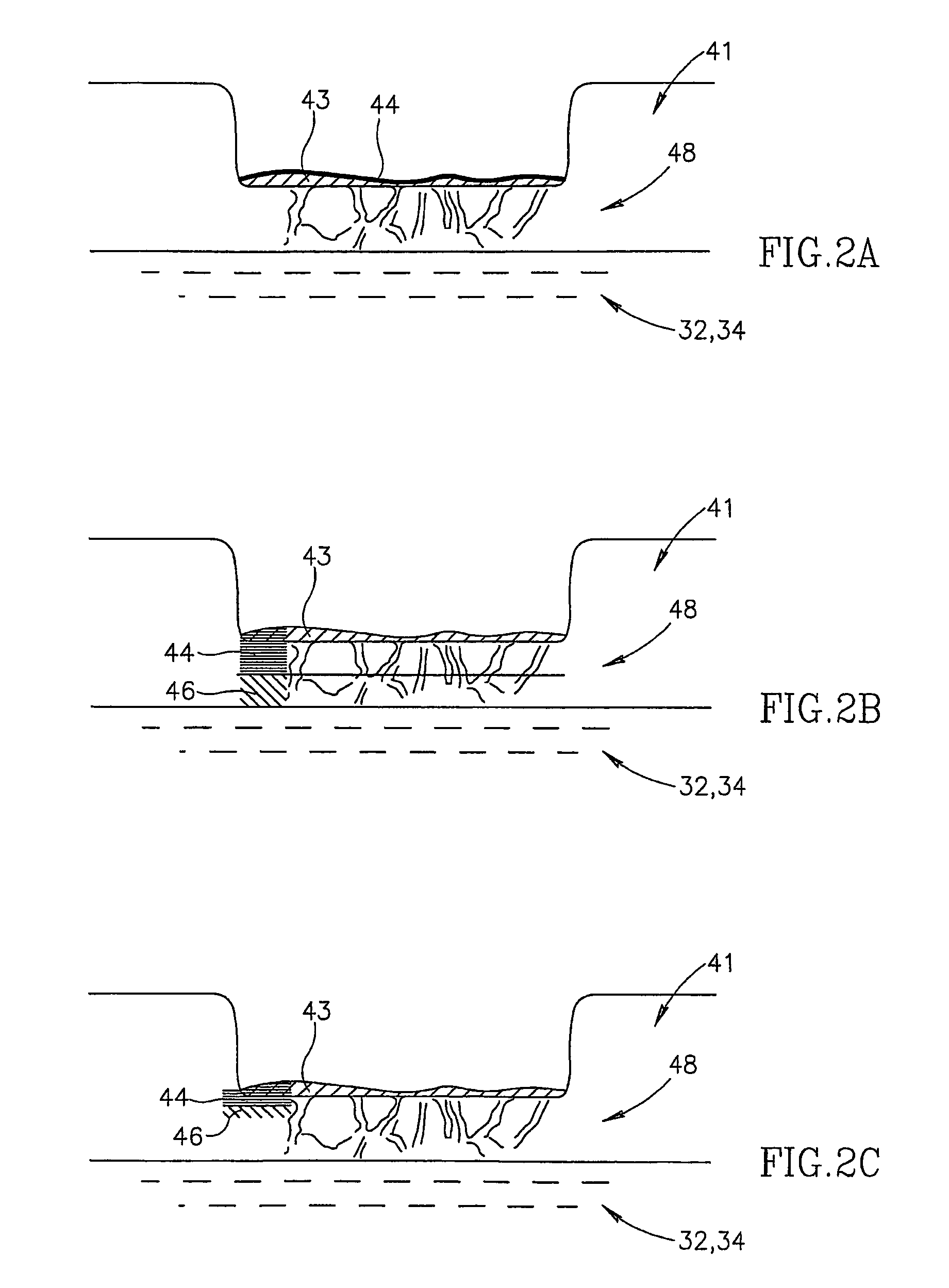 Non-penetrating filtration surgery