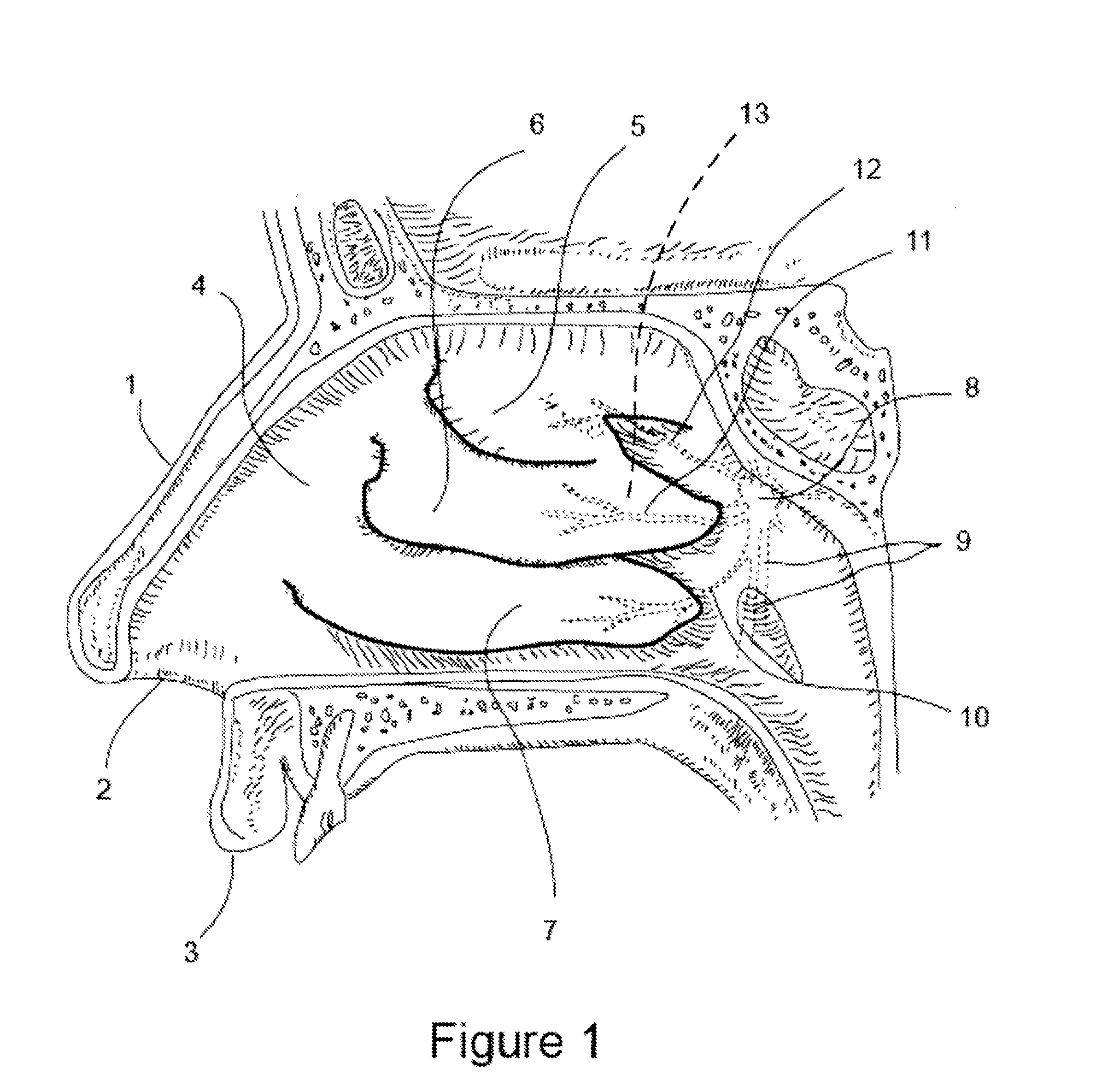 Apparatus and methods for treating rhinitis
