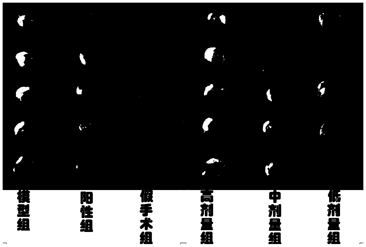 Application of scirpusin A to preparation of medicines for resisting stroke