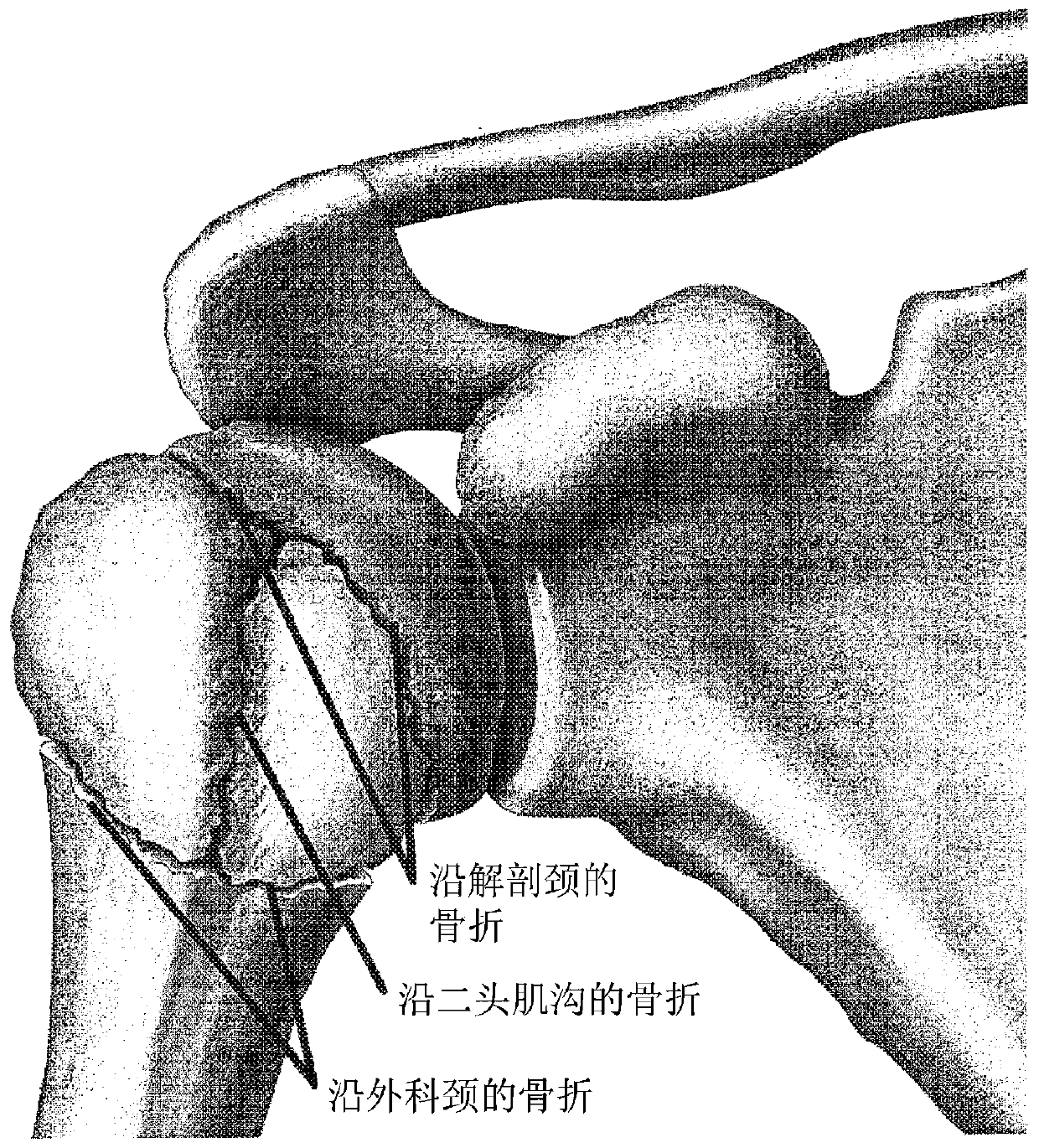 Platform fracture fixation implants