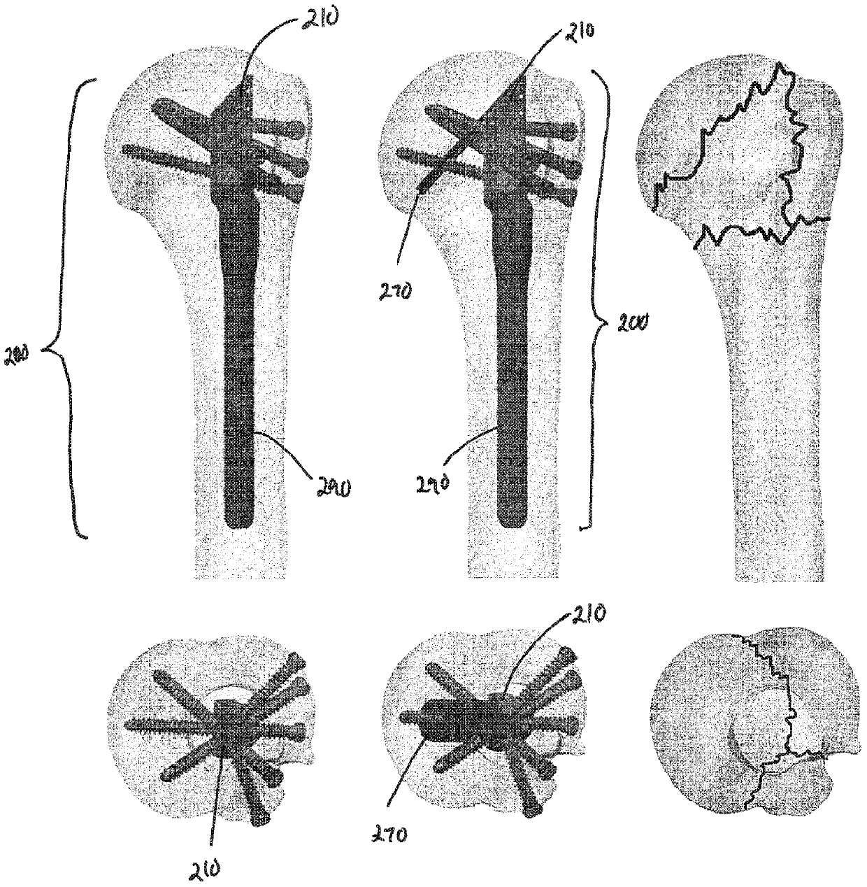 Platform fracture fixation implants