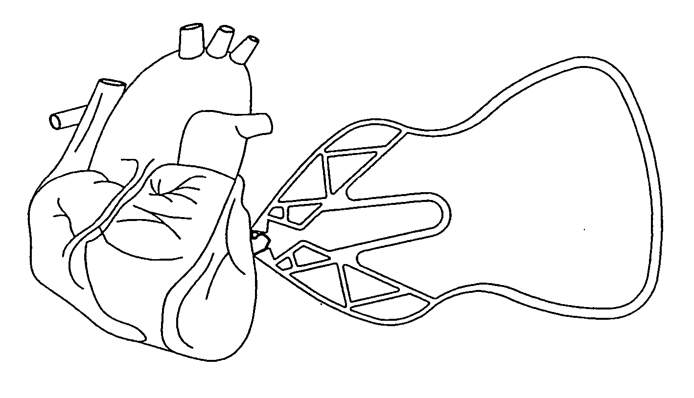 Clip and method for epicardial placement of temporary heart pacing electrodes