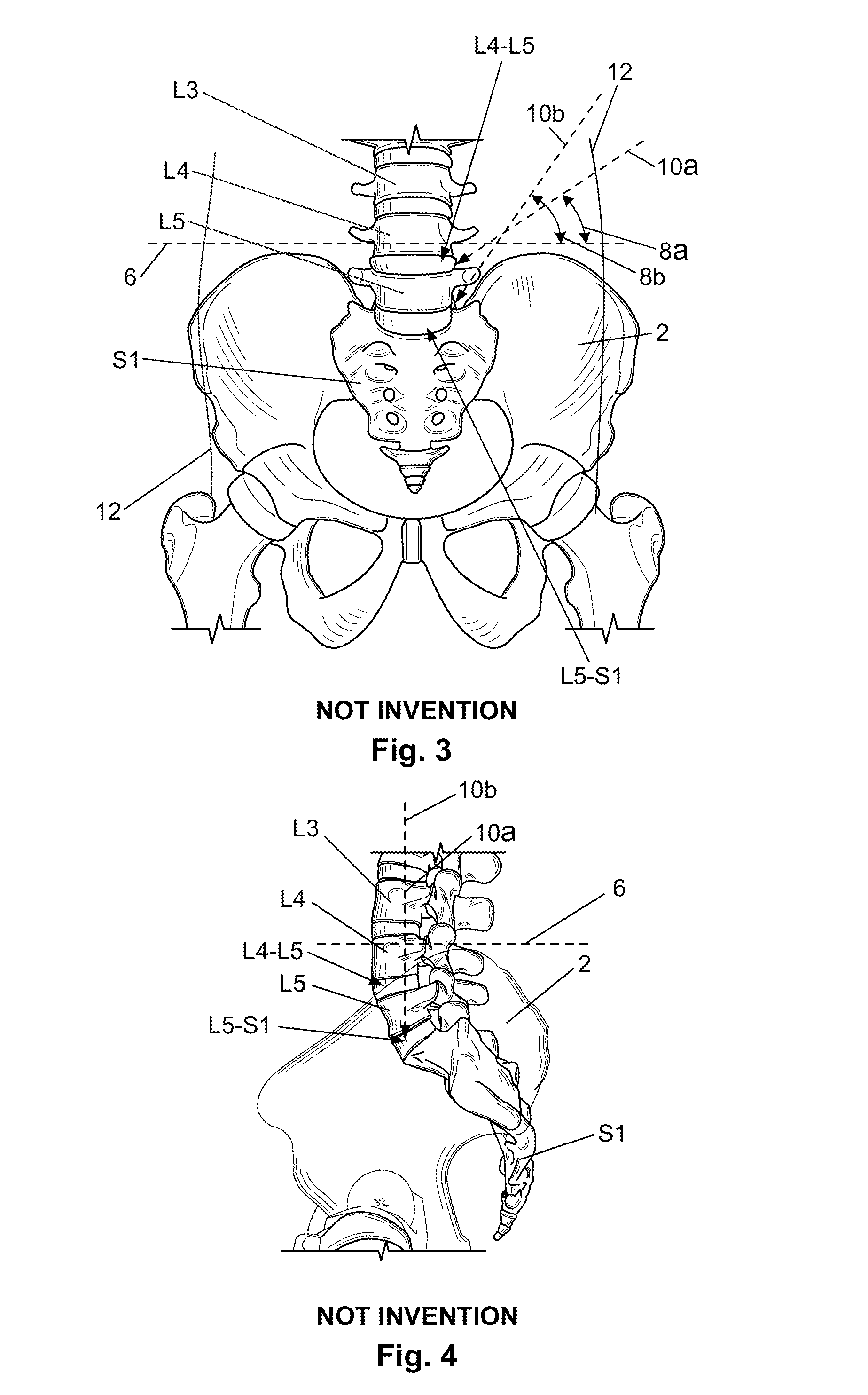 Support device and method of use