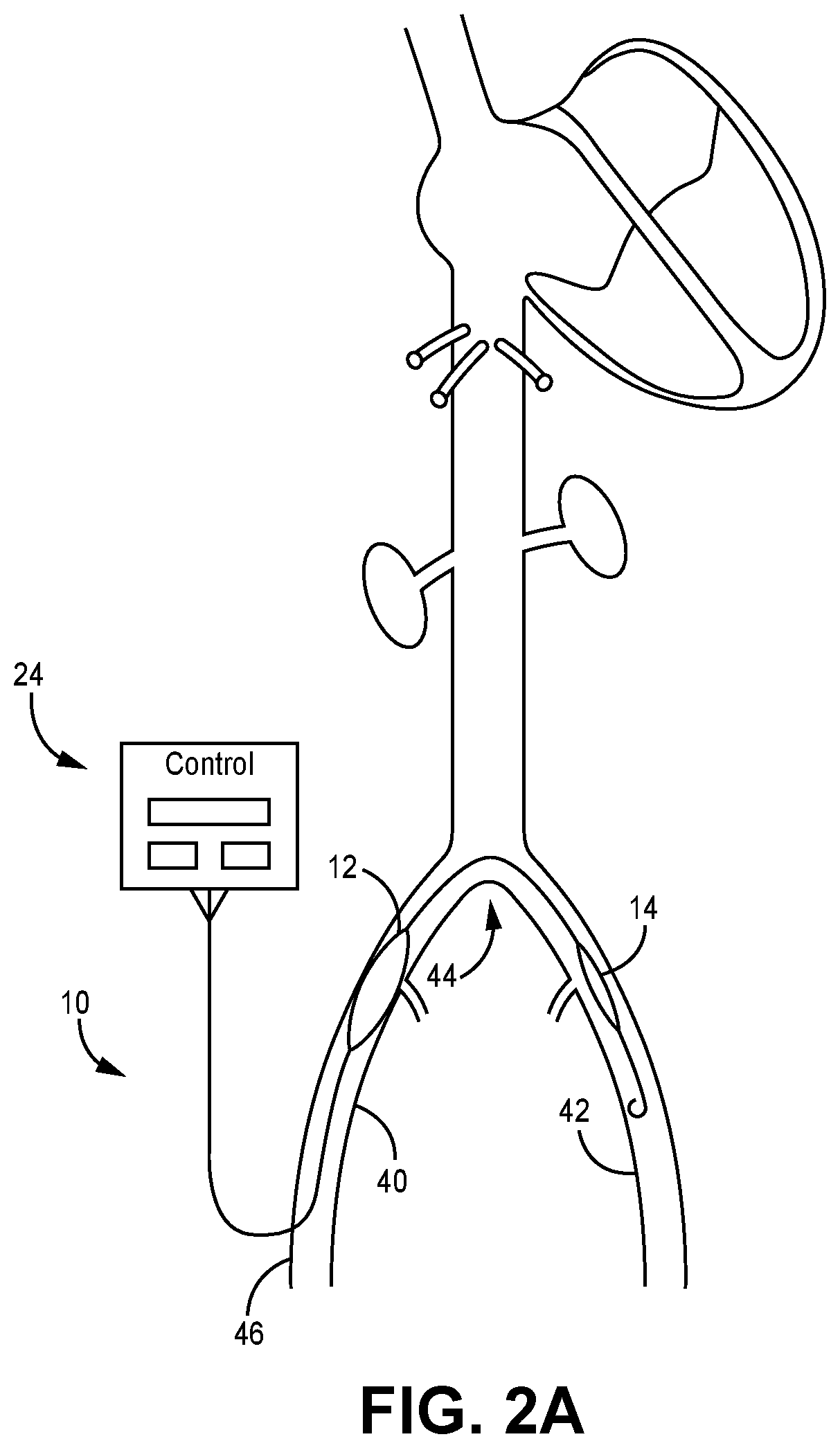 Dual Balloon Catheter and Related Methods for Treatment of Heart Failure