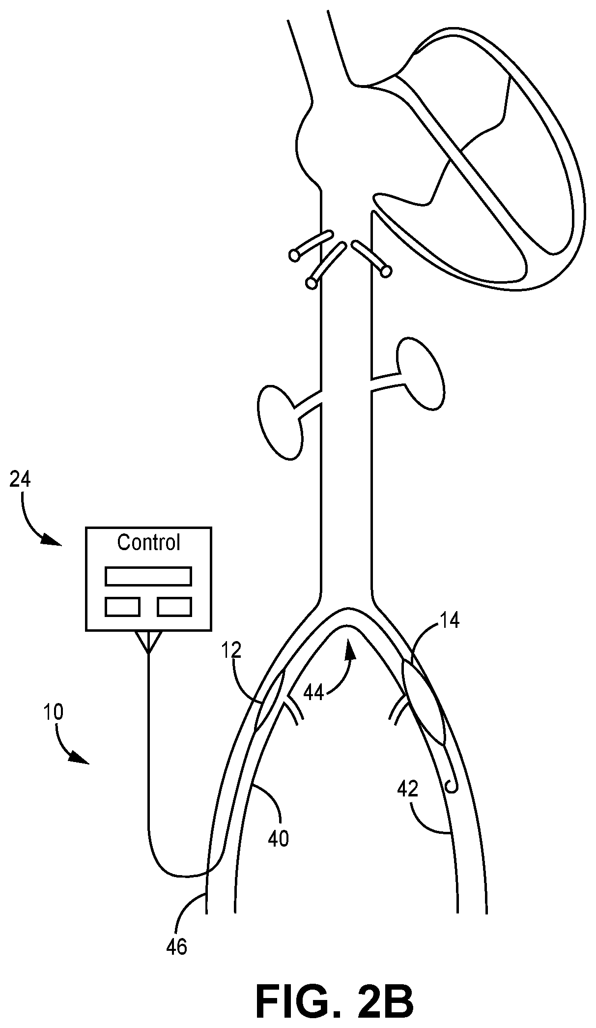 Dual Balloon Catheter and Related Methods for Treatment of Heart Failure