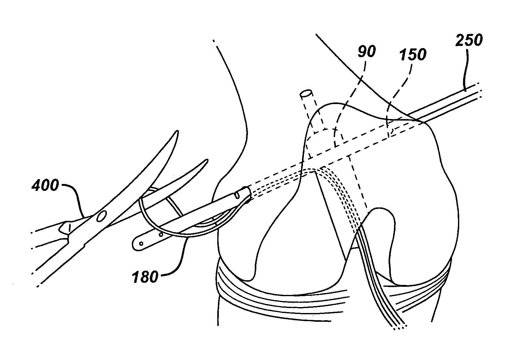 Method of replacing an anterior cruciate ligament in the knee