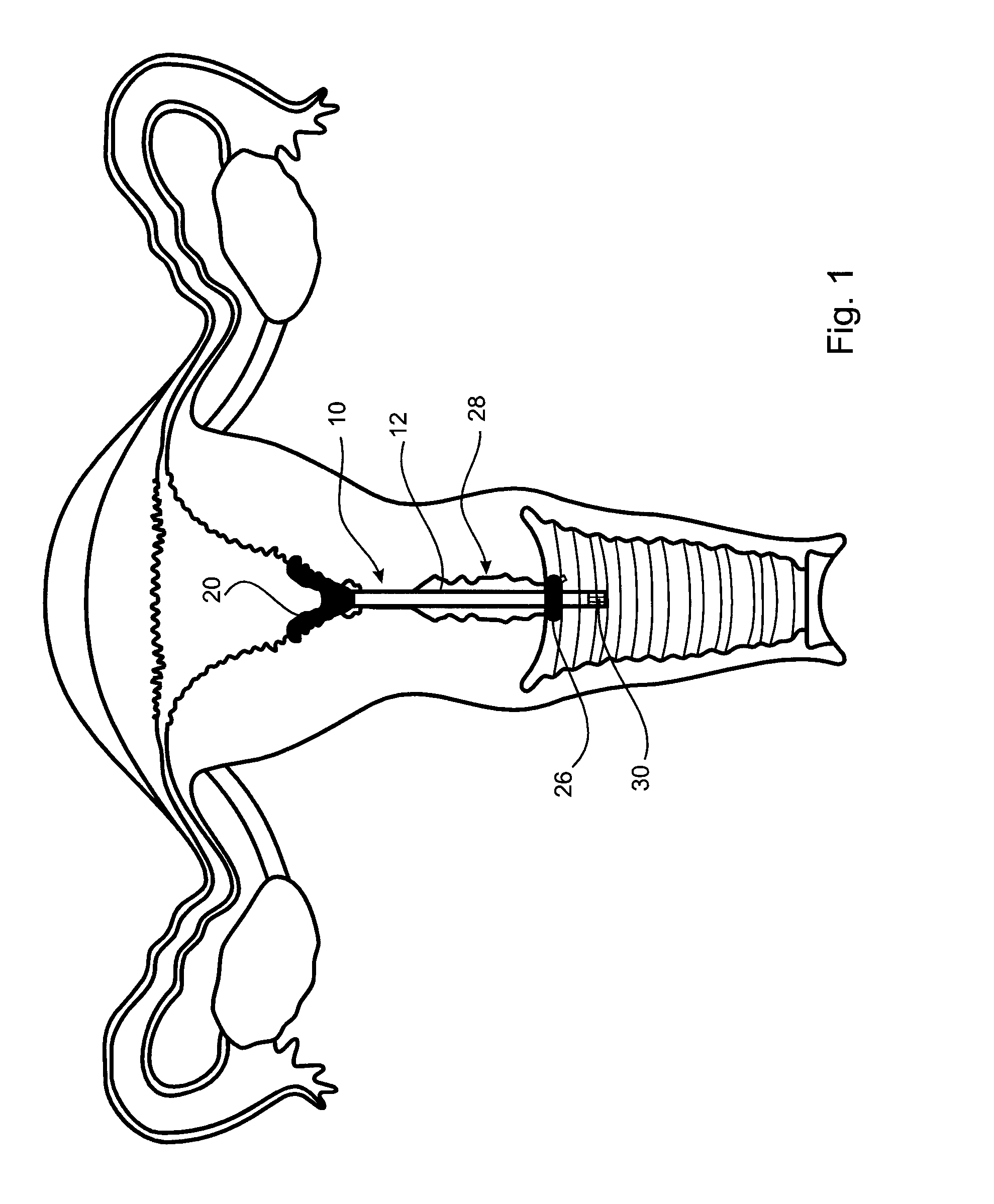 Therapeutic substance transfer catheter and method