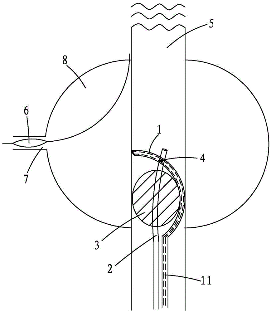 Interventional therapy device and method realizing steering and positioning fenestration through laser catheter