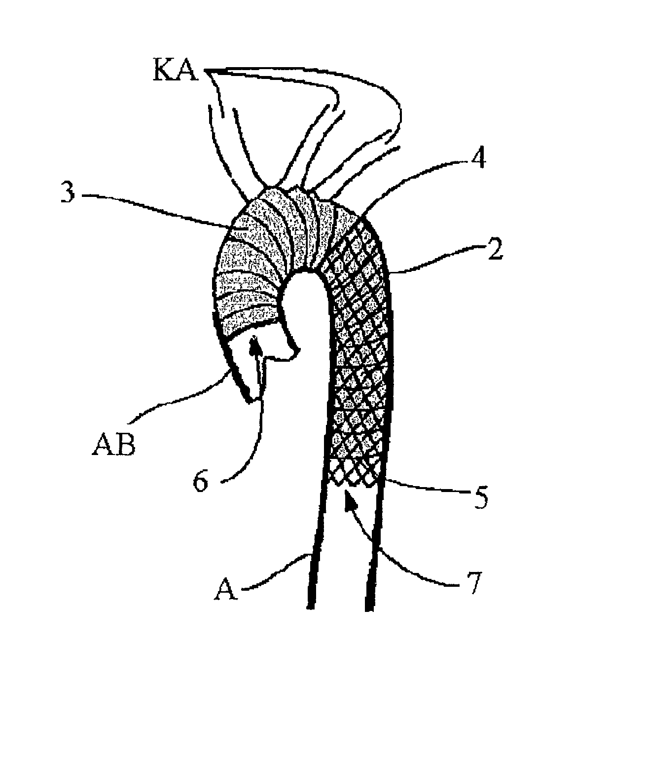 Implantation device for an aorta in an aortic arch