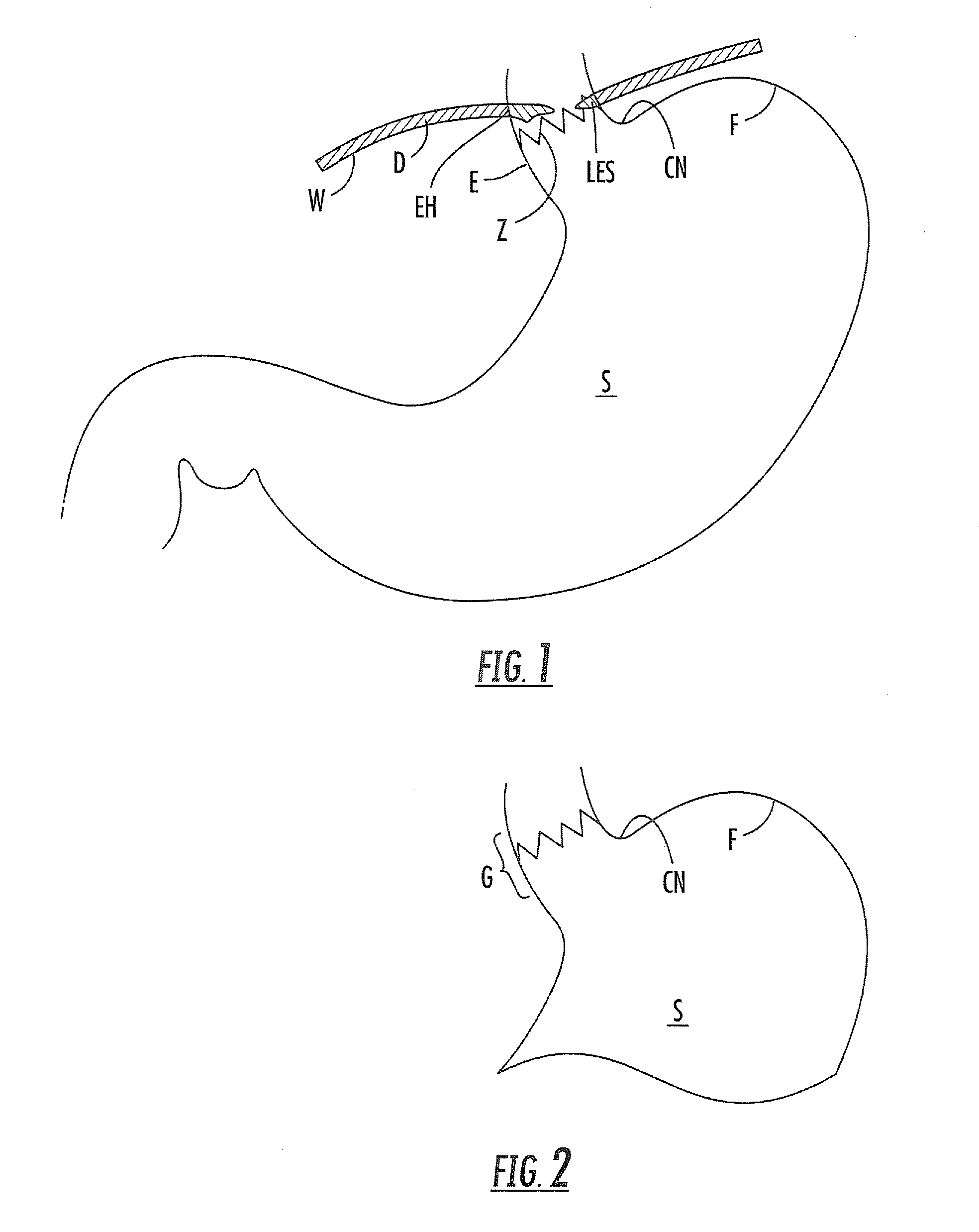 Devices for treating gastroesophageal reflux disease and hiatal hernia, and methods of treating gastroesophageal reflux disease and hiatal hernia using same