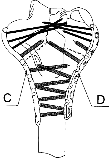 Locking bone fracture plate for far back outer side of humerus