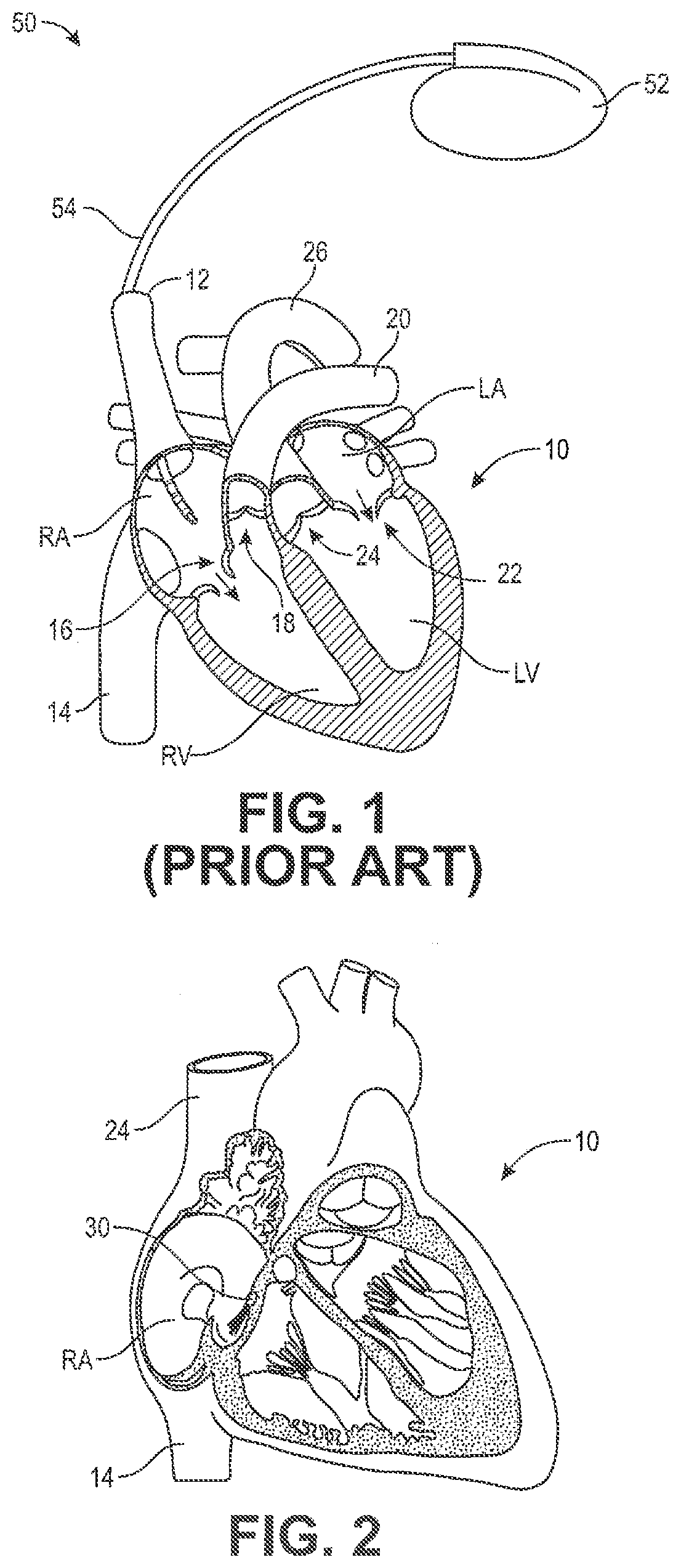 Delivery device having a deflectable and peelable mapping guide sheath for his bundle pacing
