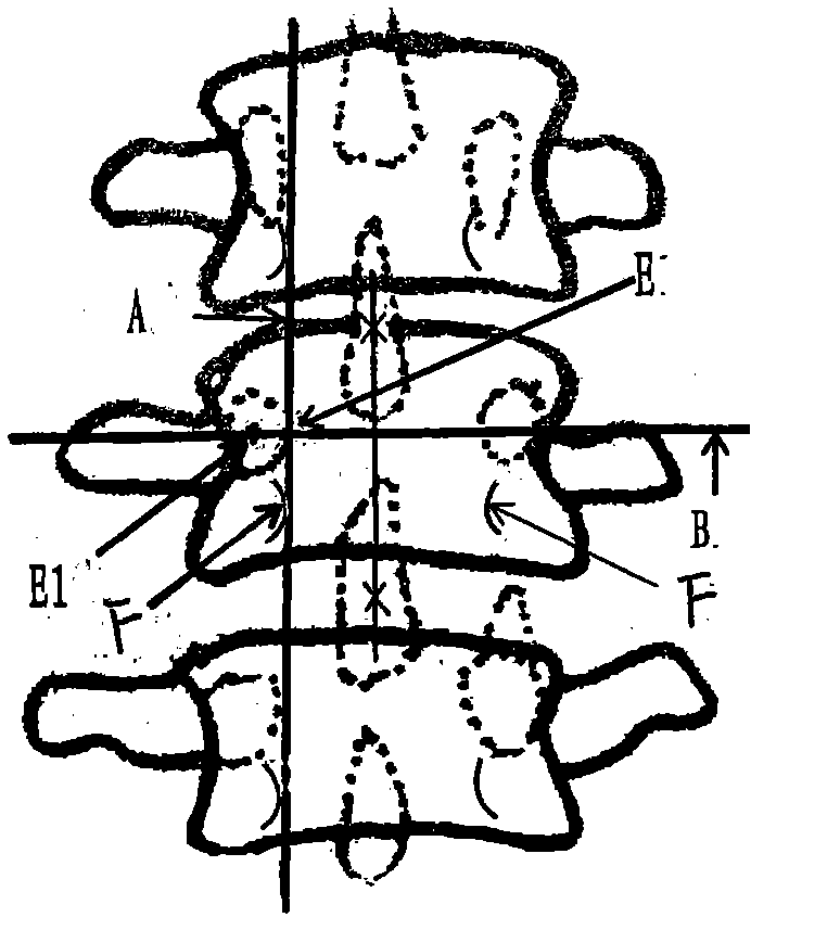 X-ray-film-based method for locating coordinates of pedicle screws