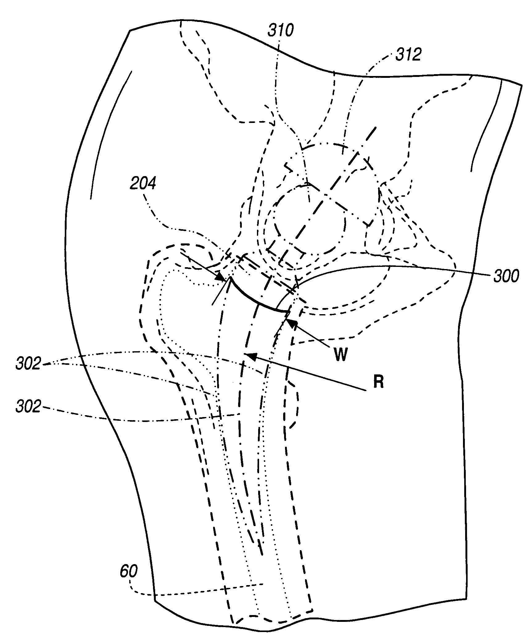 Method and apparatus for providing a short-stemmed hip prosthesis