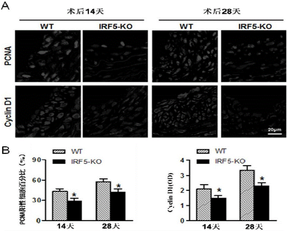 Function and application of IRF5 (interferon regulatory factor-5) and IRF5 inhibitor in treatment of restenosis after VI (vascular injury)