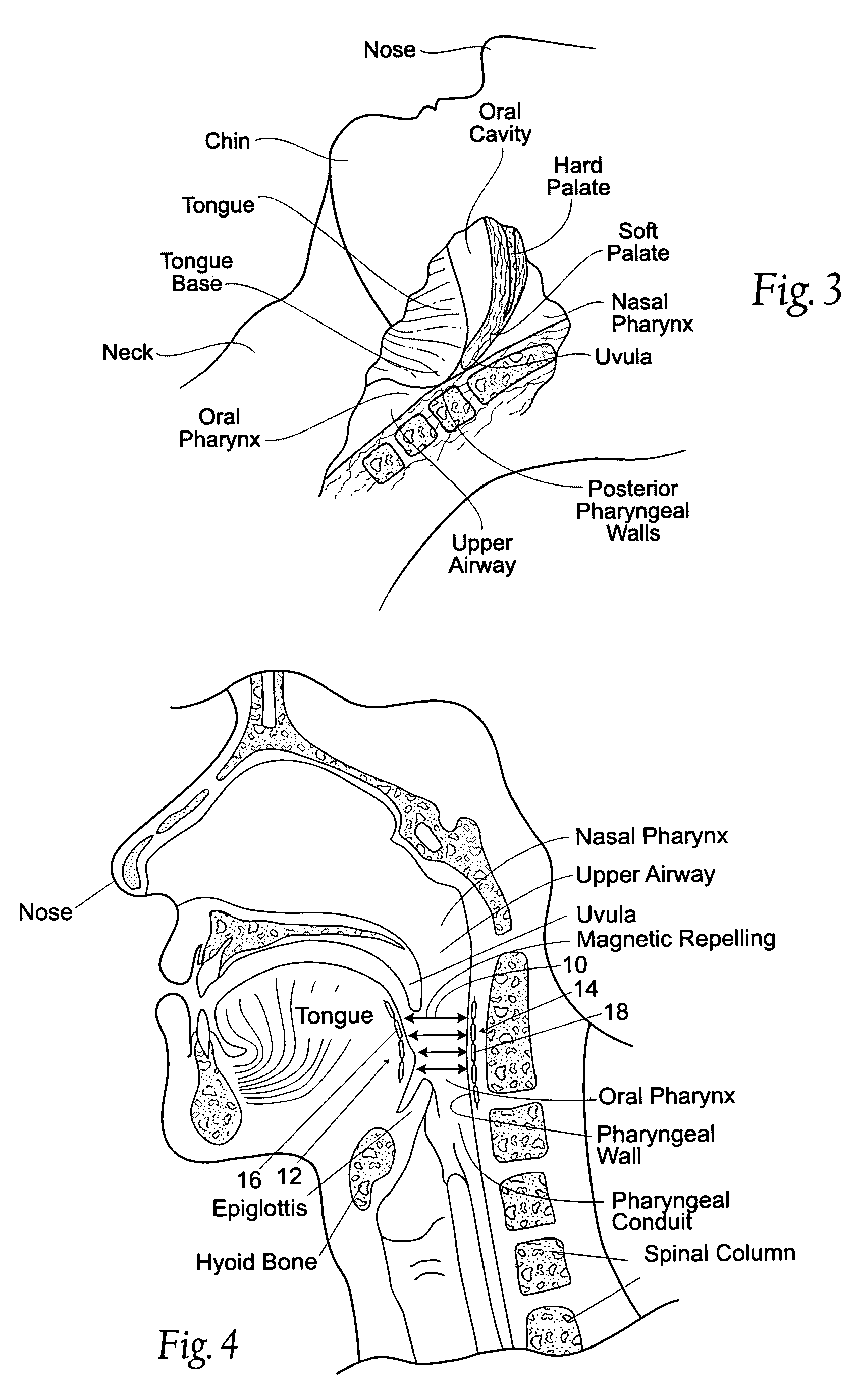 Devices, systems and methods using magnetic force systems in the tongue