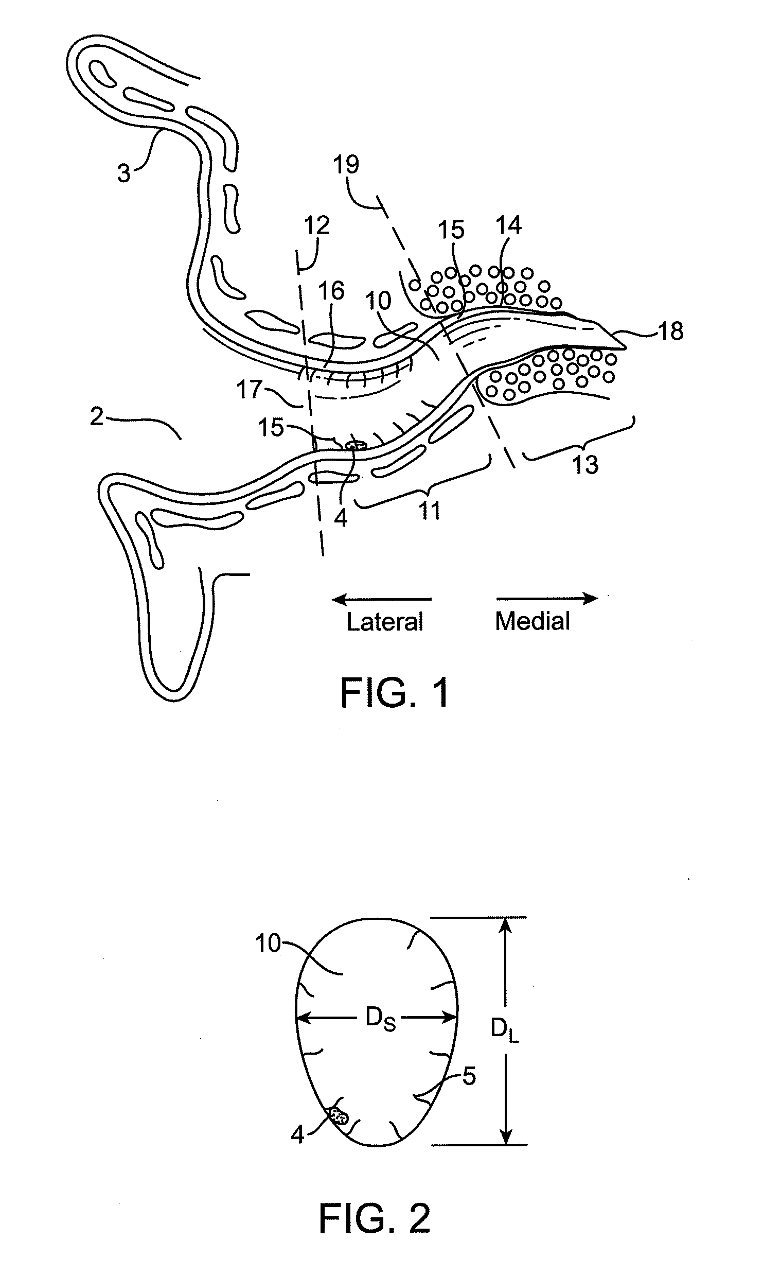 Tool for insertion and removal of in-canal hearing devices