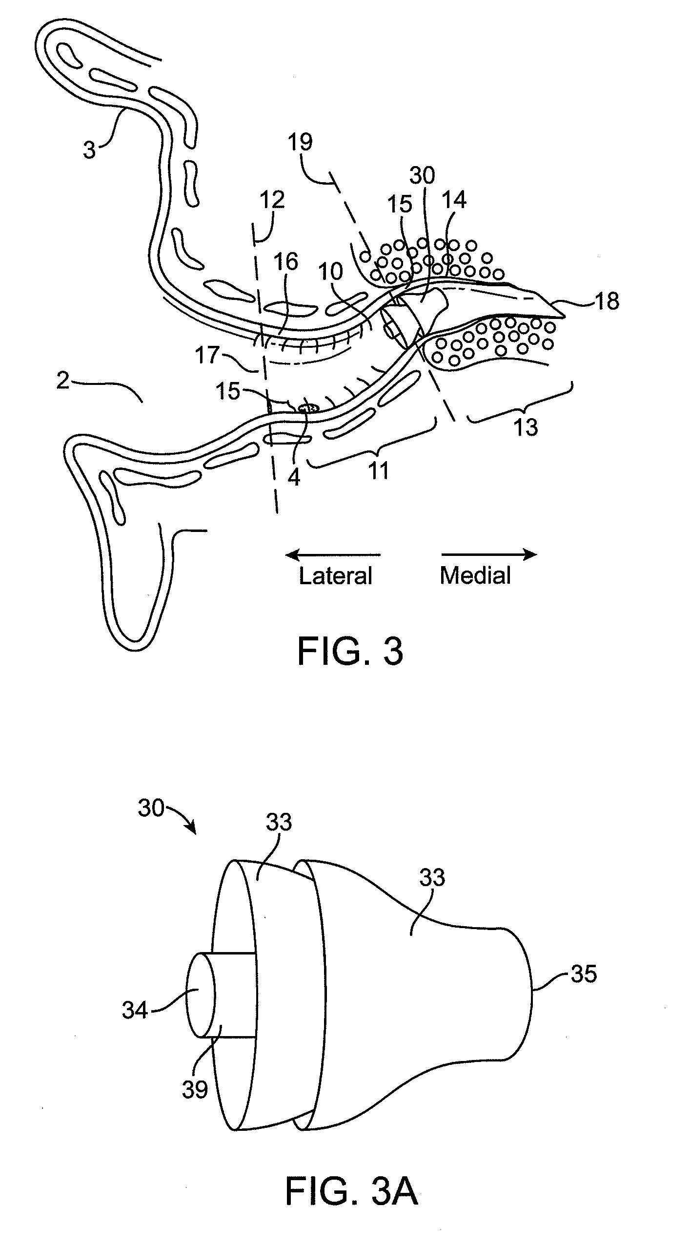 Tool for insertion and removal of in-canal hearing devices