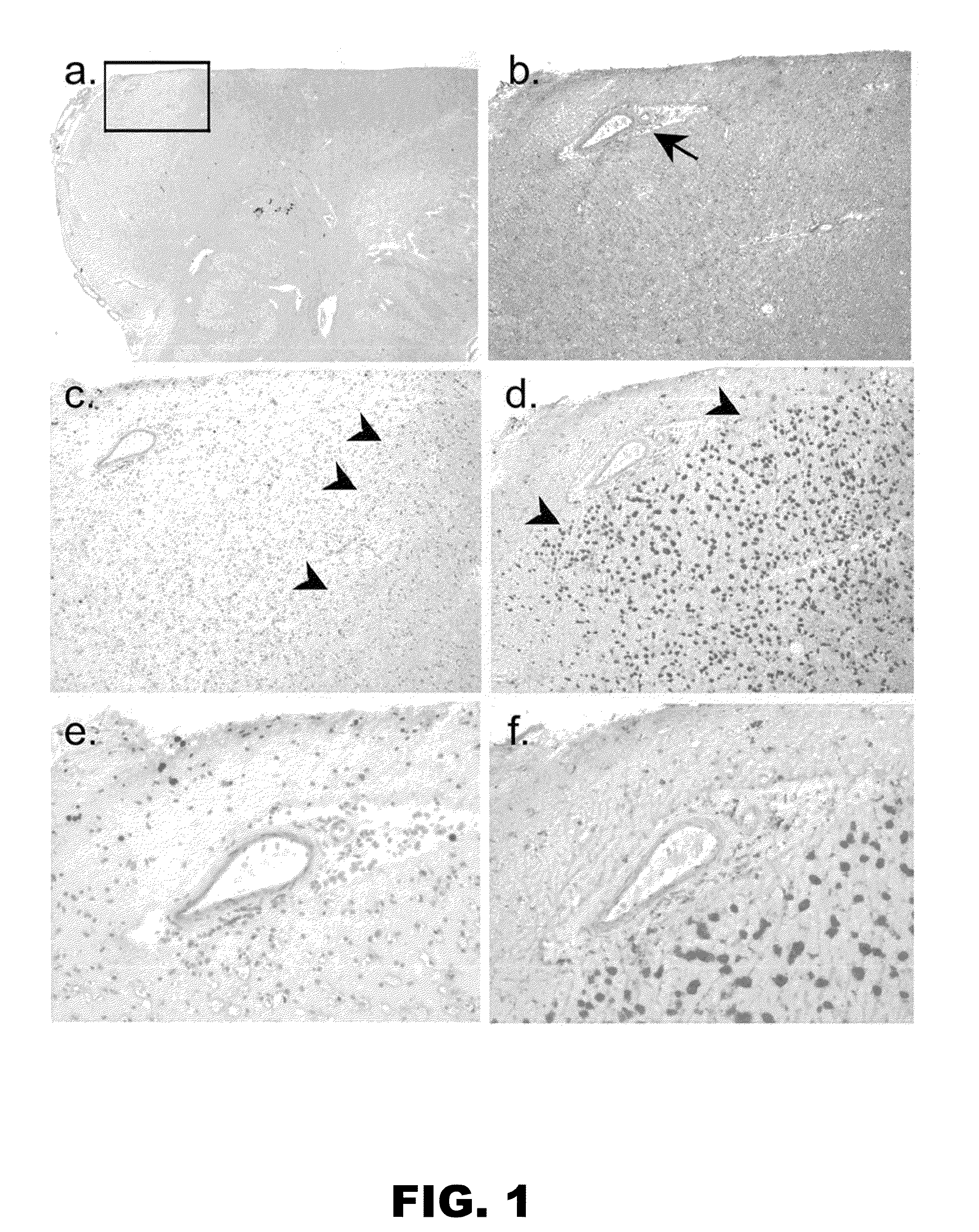 Method for detecting inflammatory disorders of the central nervous system