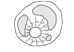 Processing method of atherosclerotic plaque medical image