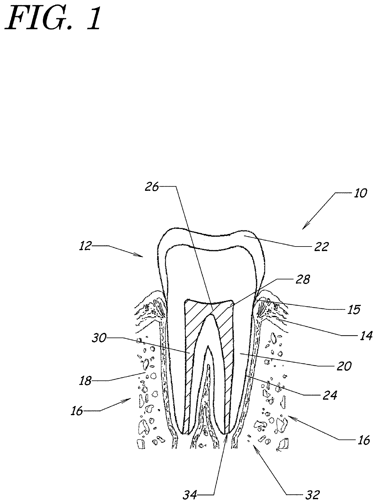 Apparatus, methods, and compositions for endodontic treatments