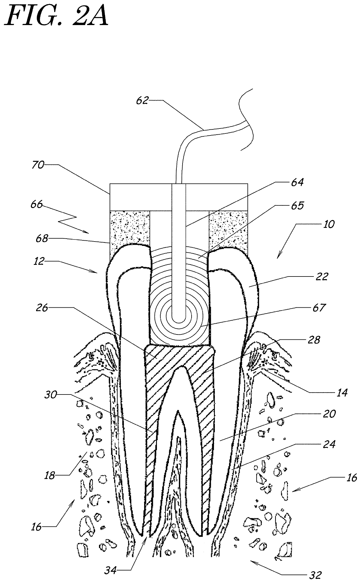 Apparatus, methods, and compositions for endodontic treatments