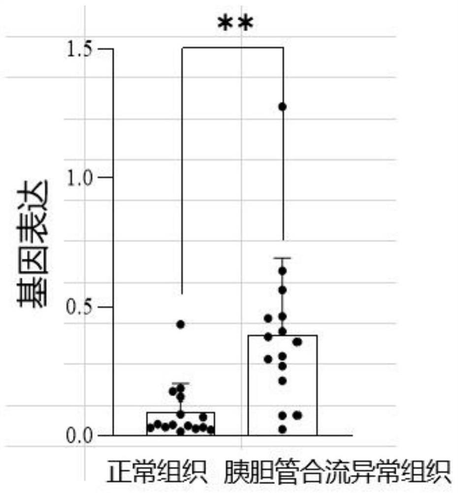 Marker related to abnormal pancreaticobiliary confluence and application thereof