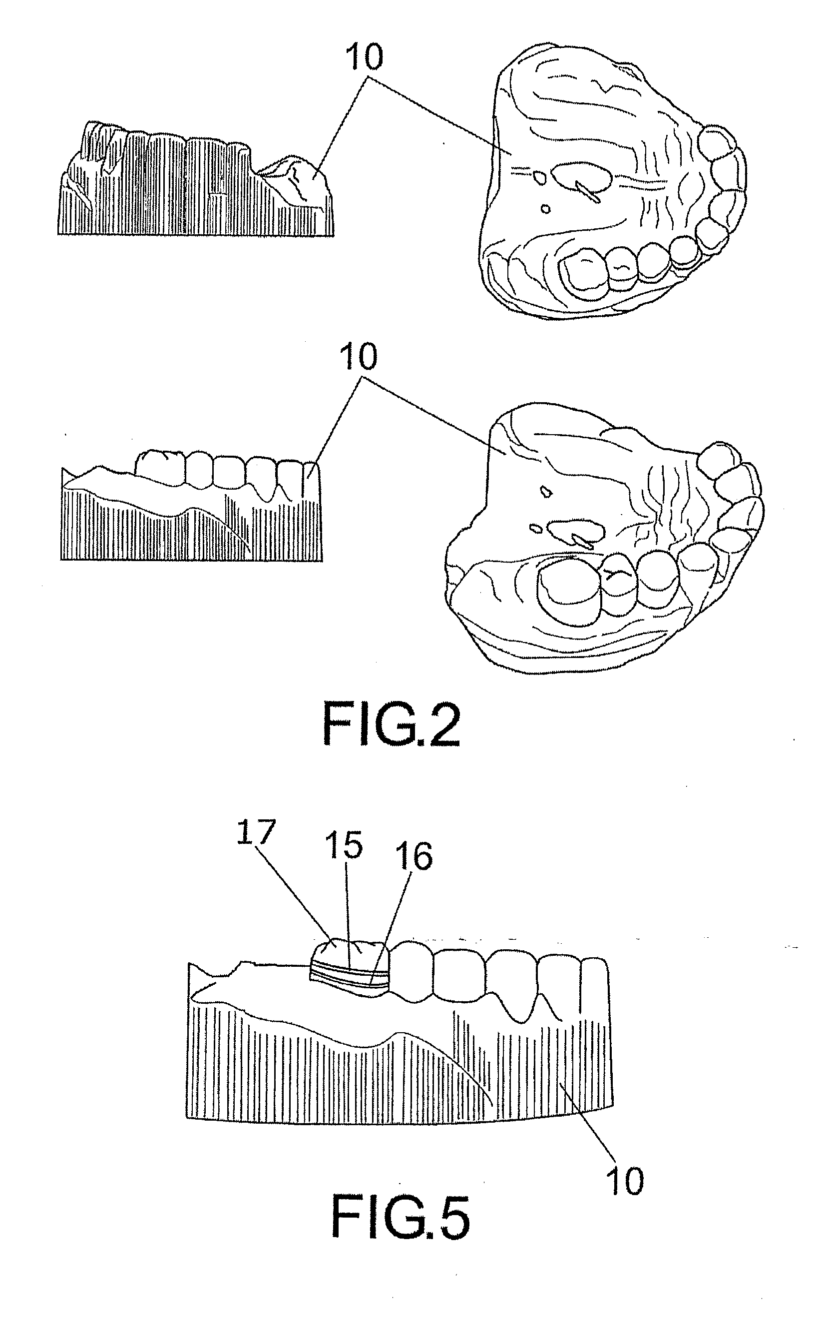 Method for manufacturing digitally-designed removable dental prostheses and system required for this purpose