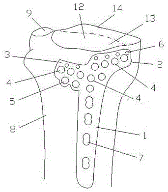 Internal fixation plate for tibial plateau three-column dissection
