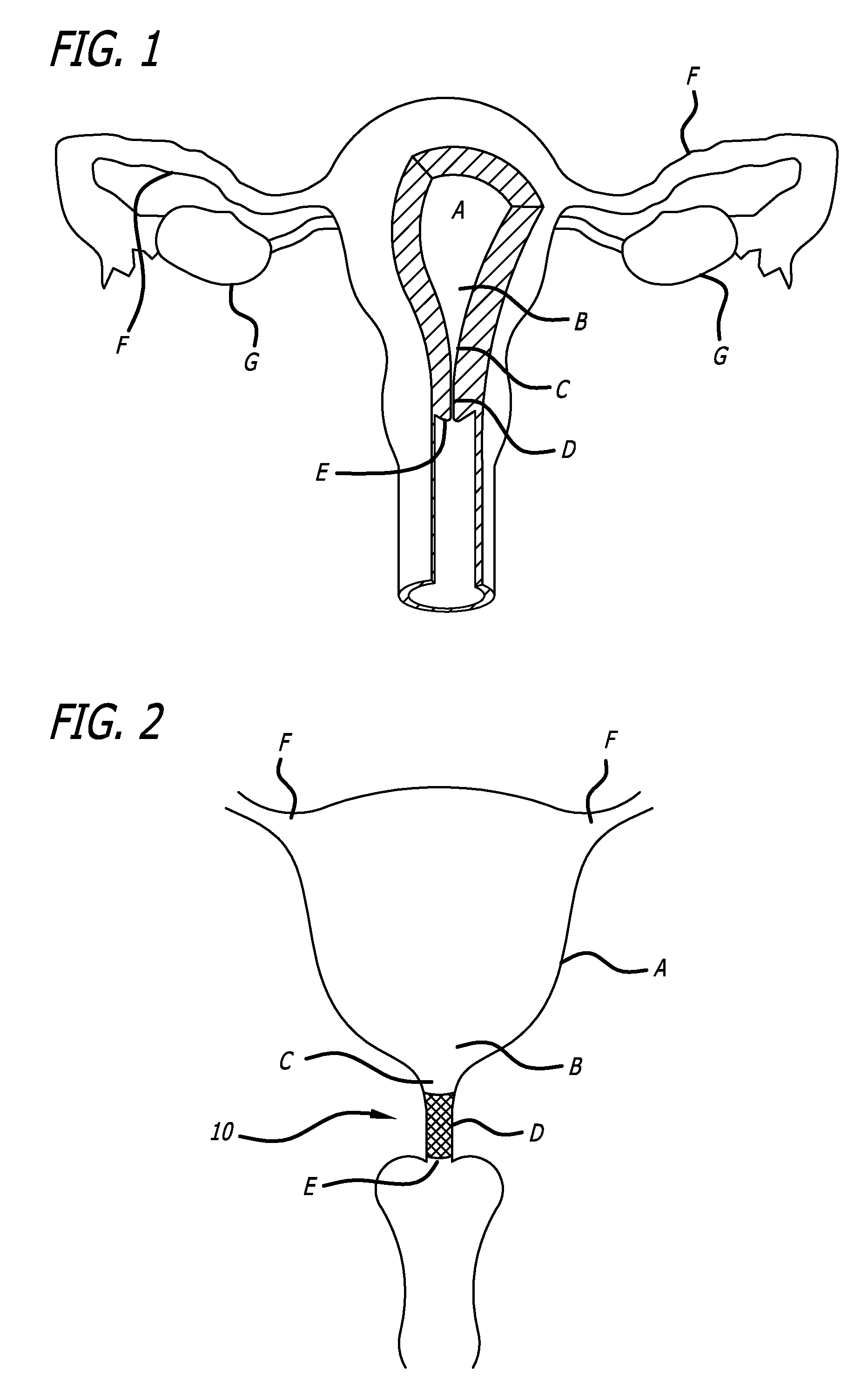 Method And Apparatus For Occluding A Lumen