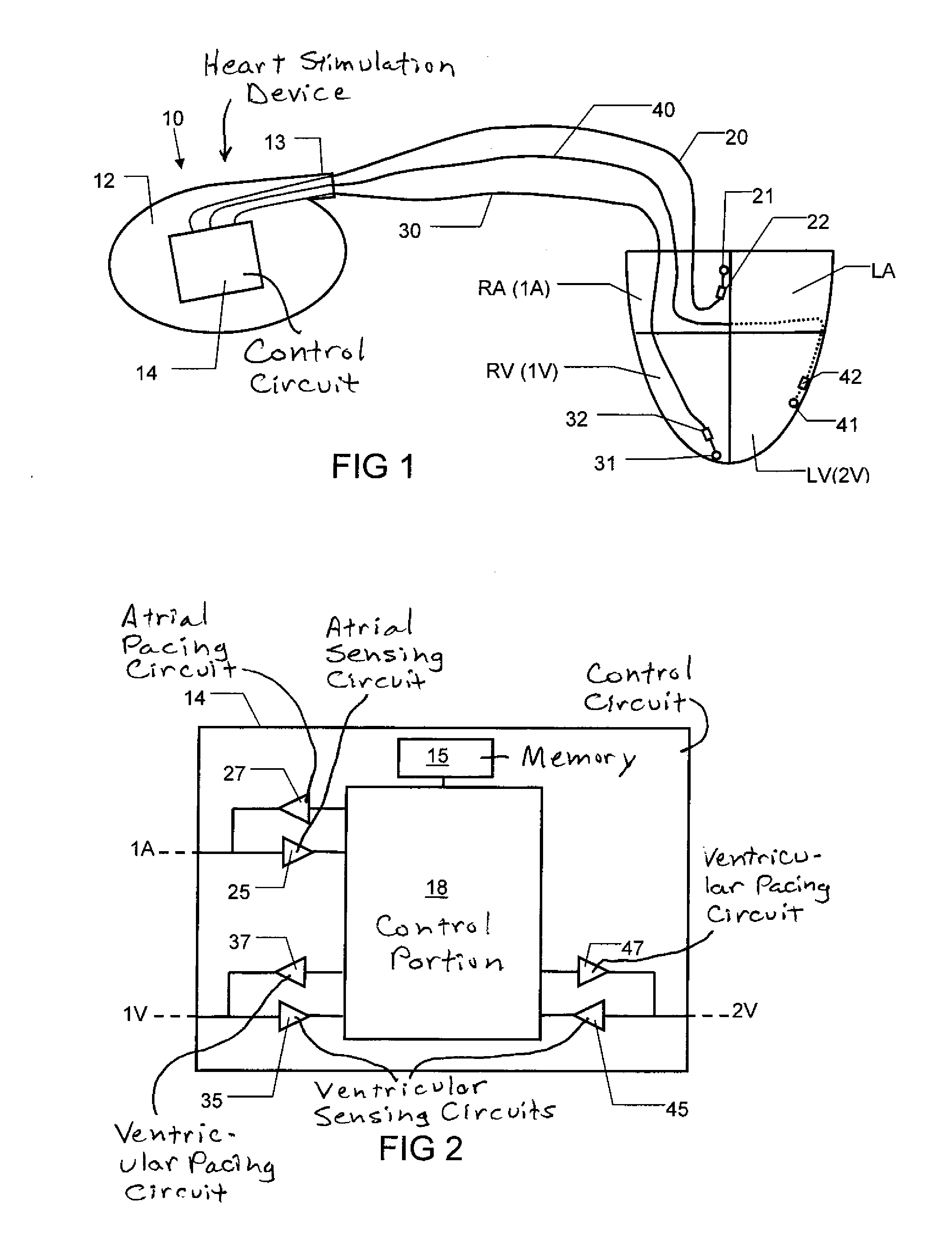 Implantable Heart Stimulation Device and Method