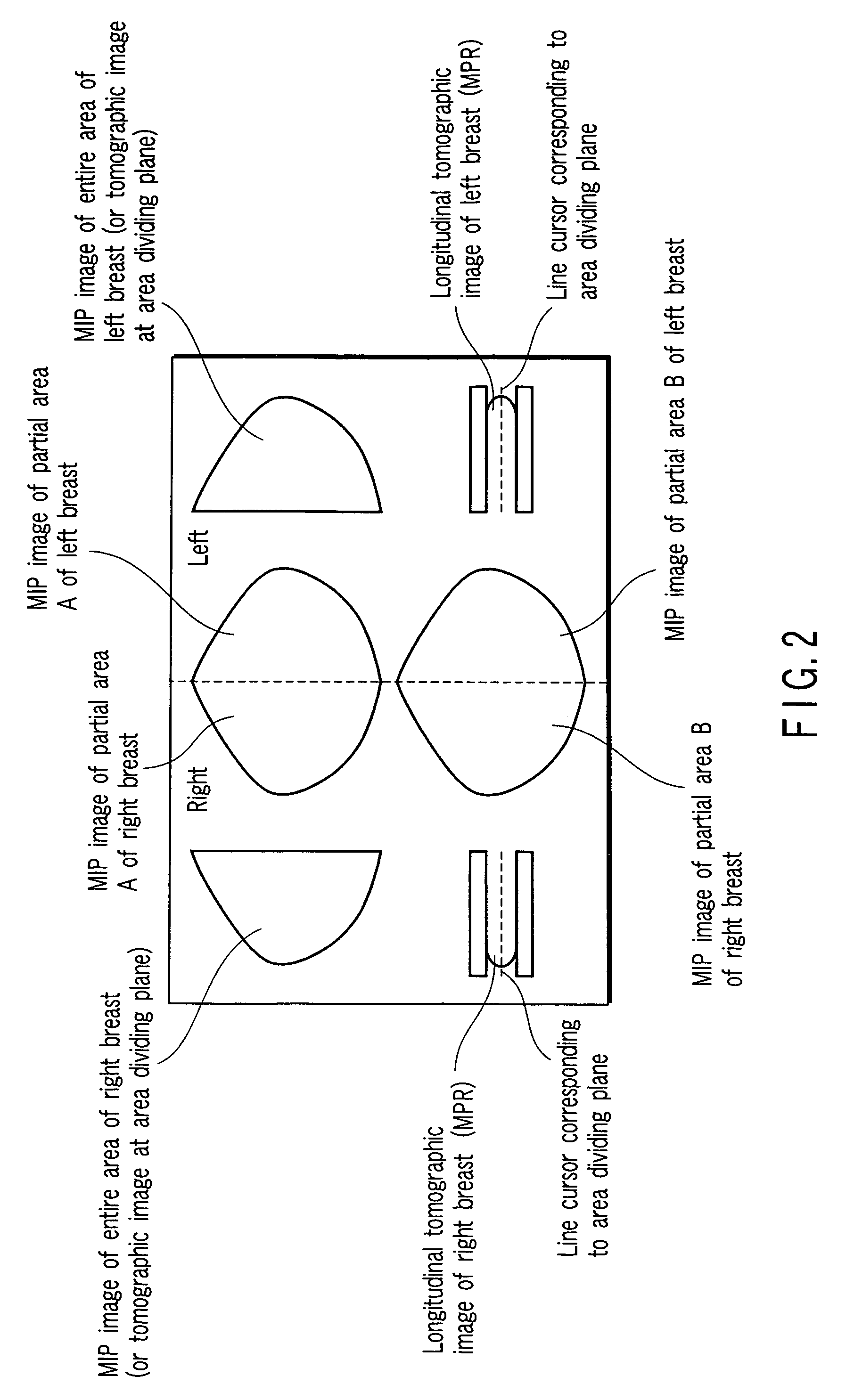 Image displaying apparatus, image displaying method, and computer readable medium for displaying an image of a mammary gland structure without overlaps thereof