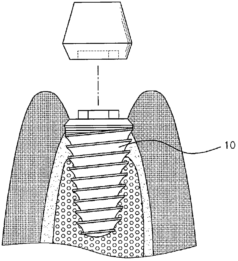 Dental implant