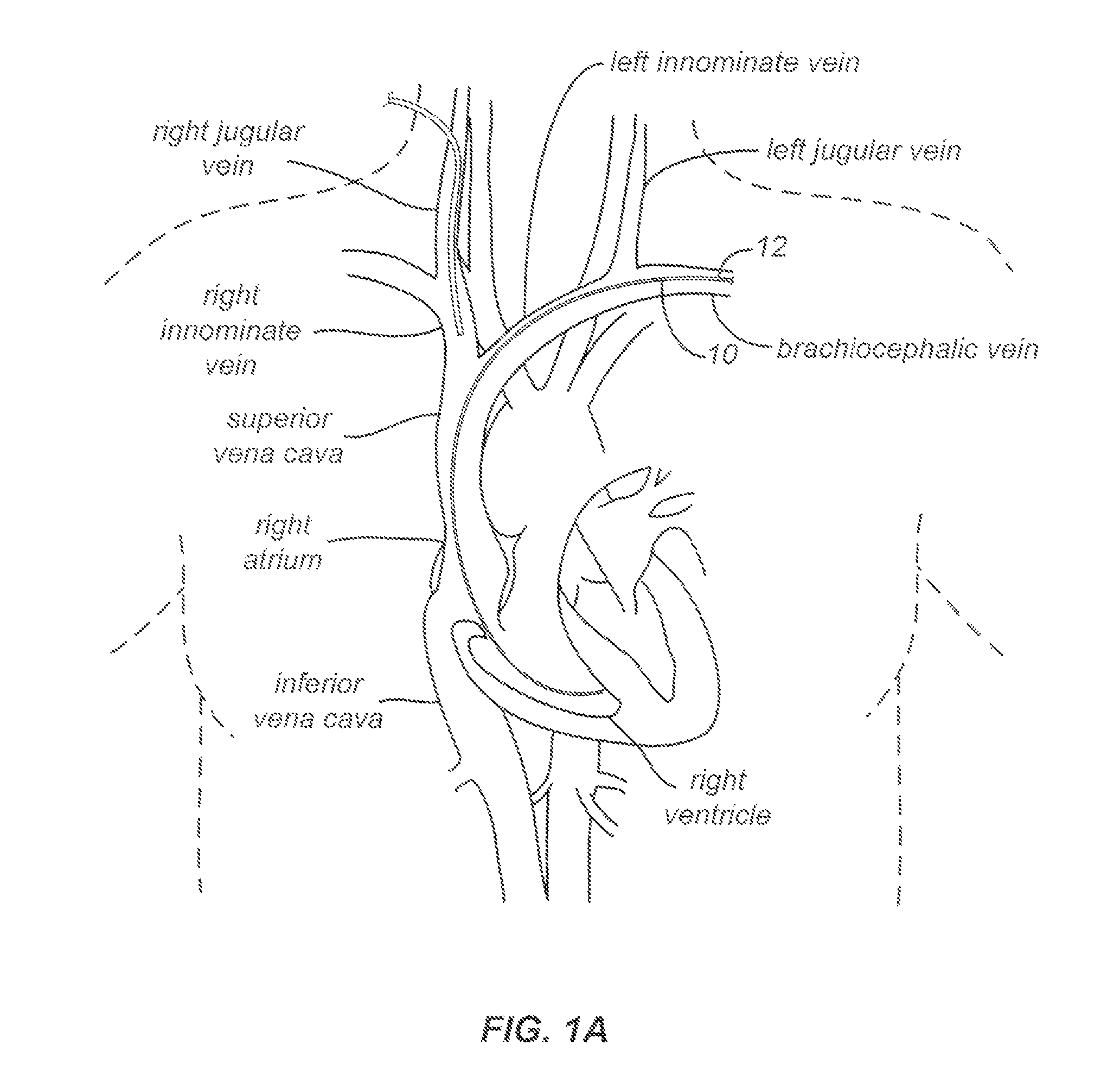 Snaring systems and methods