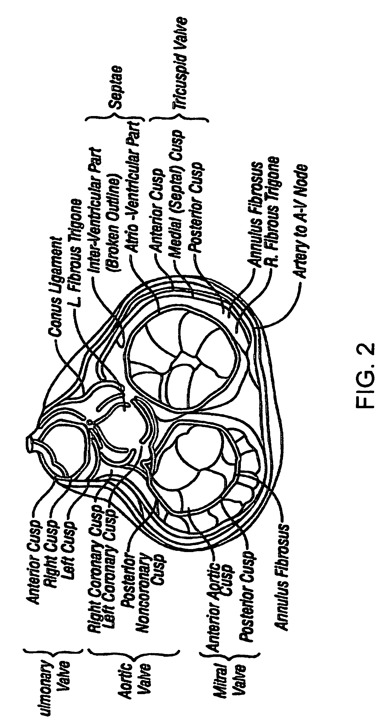 Heart band with fillable chambers to modify heart valve function