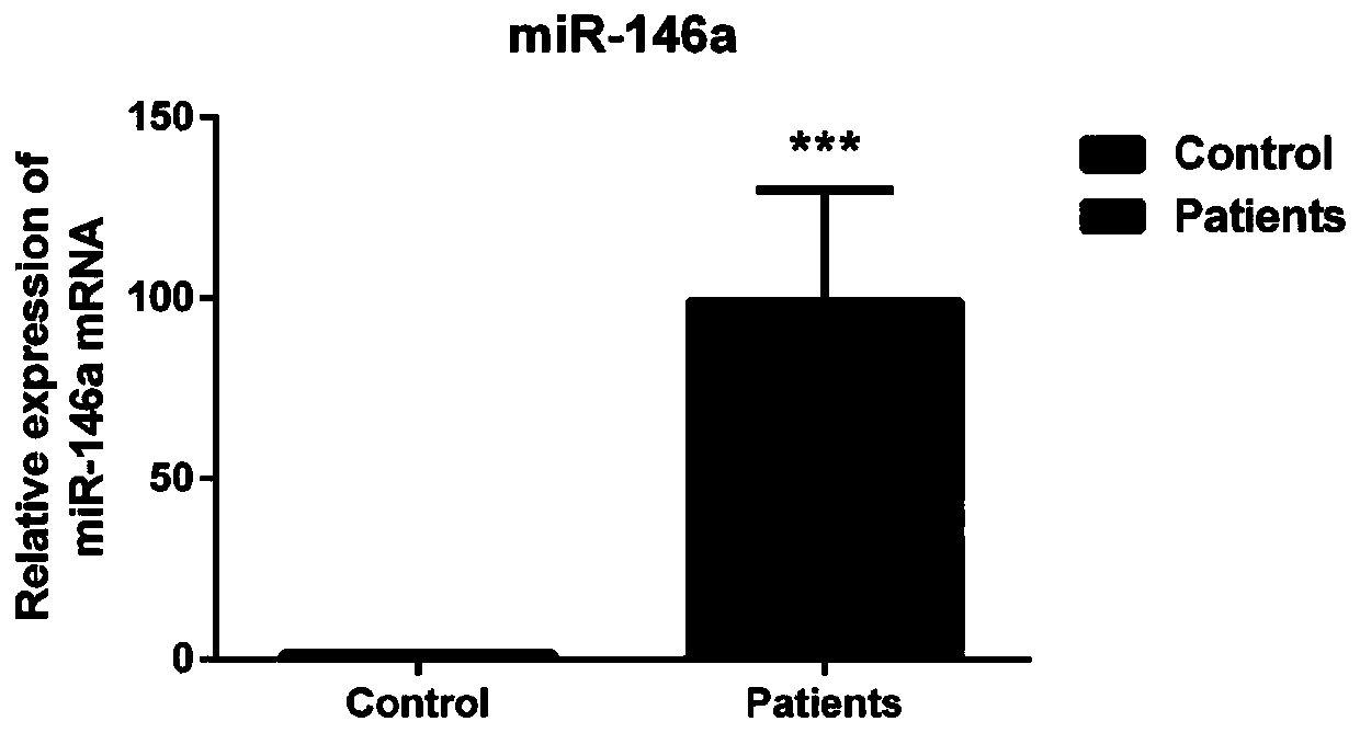 Application of MIF (migratory inhibitory factor) to preparation of product for diagnosing steroid-induced avascular necrosis of femoral head