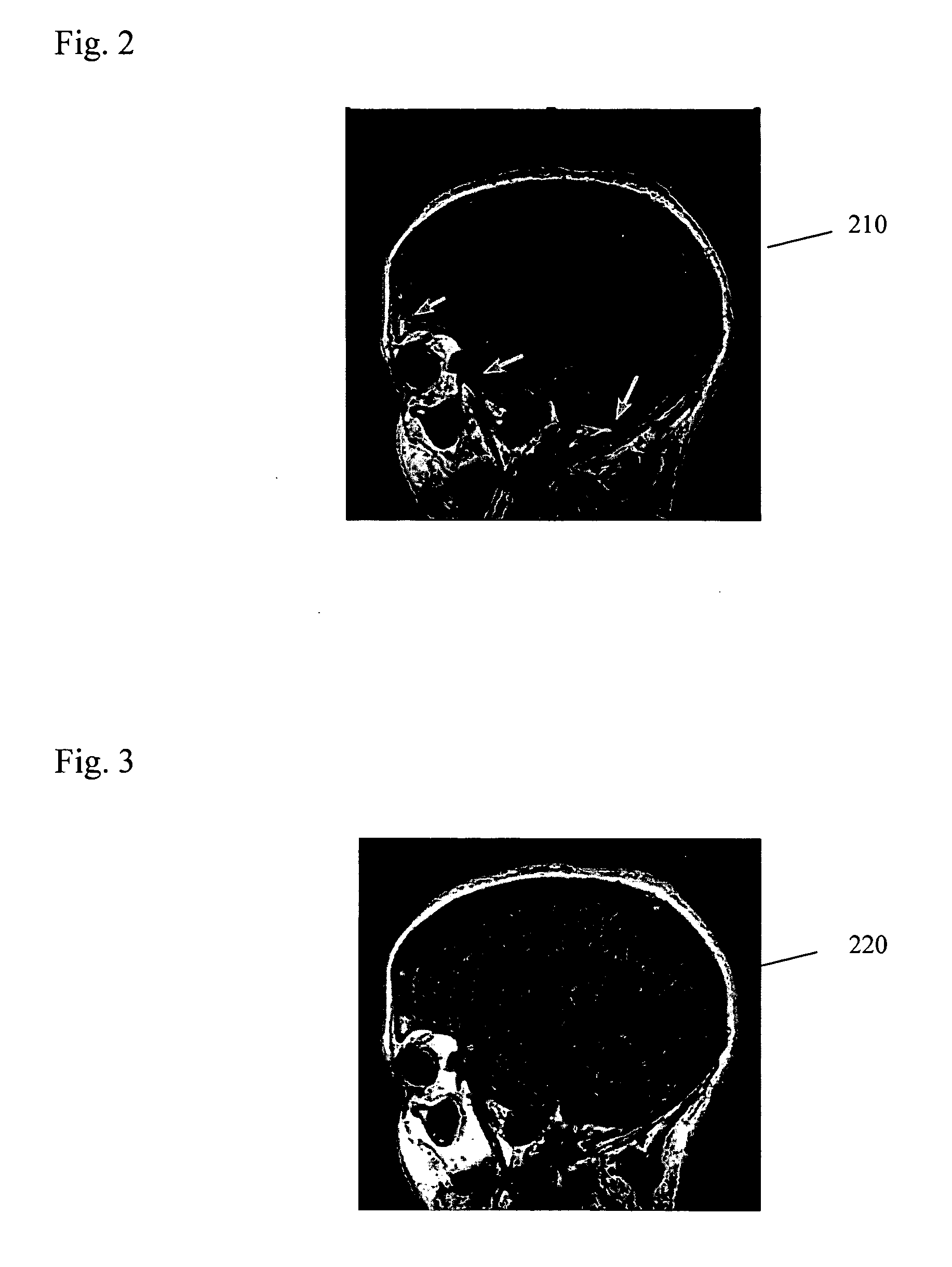 System, software arrangement and method for segmenting an image