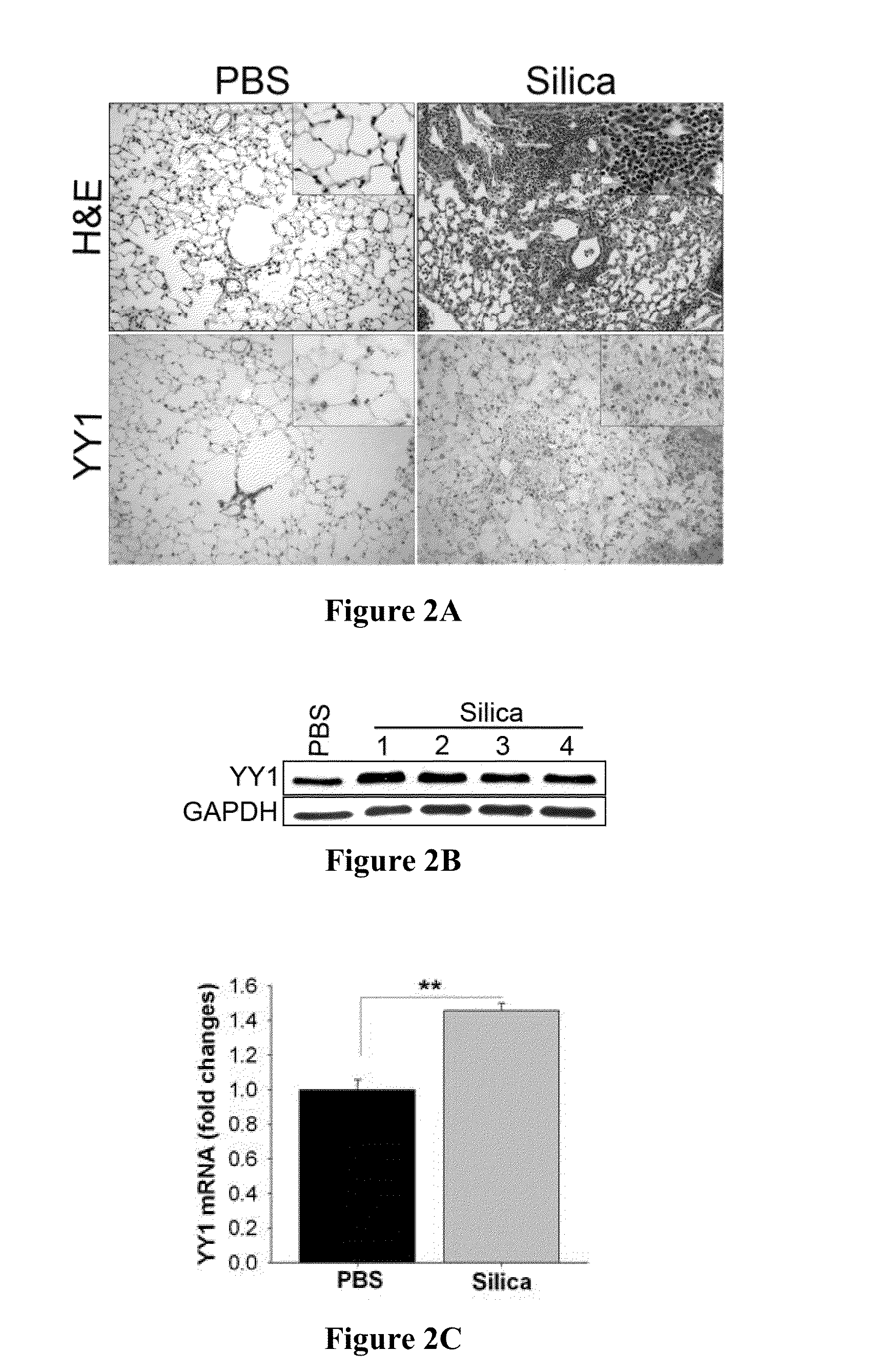 Methods of diagnosing and treating fibrosis