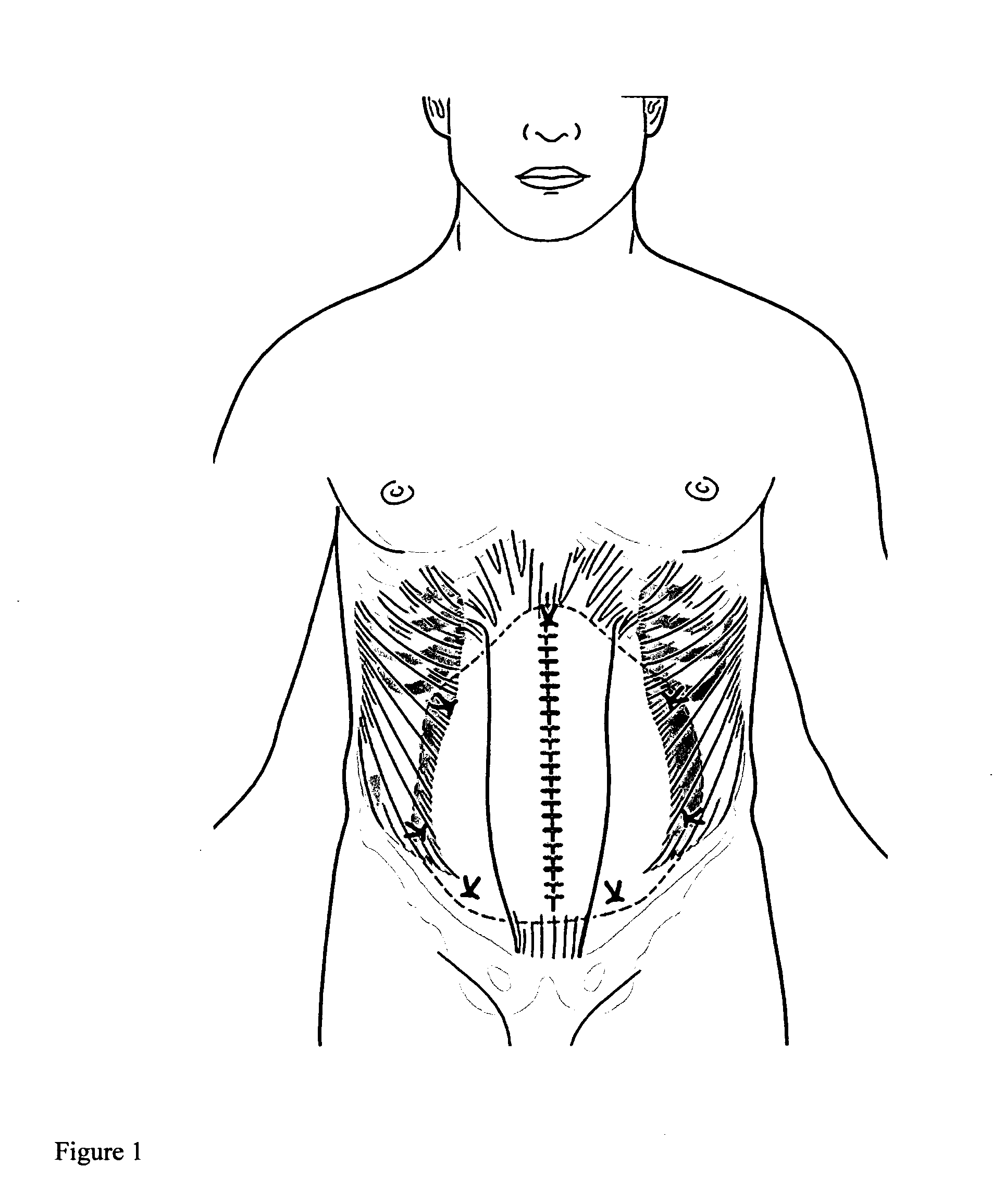 Apparatus and method for use of a biosurgical prosthetic rectus sheath