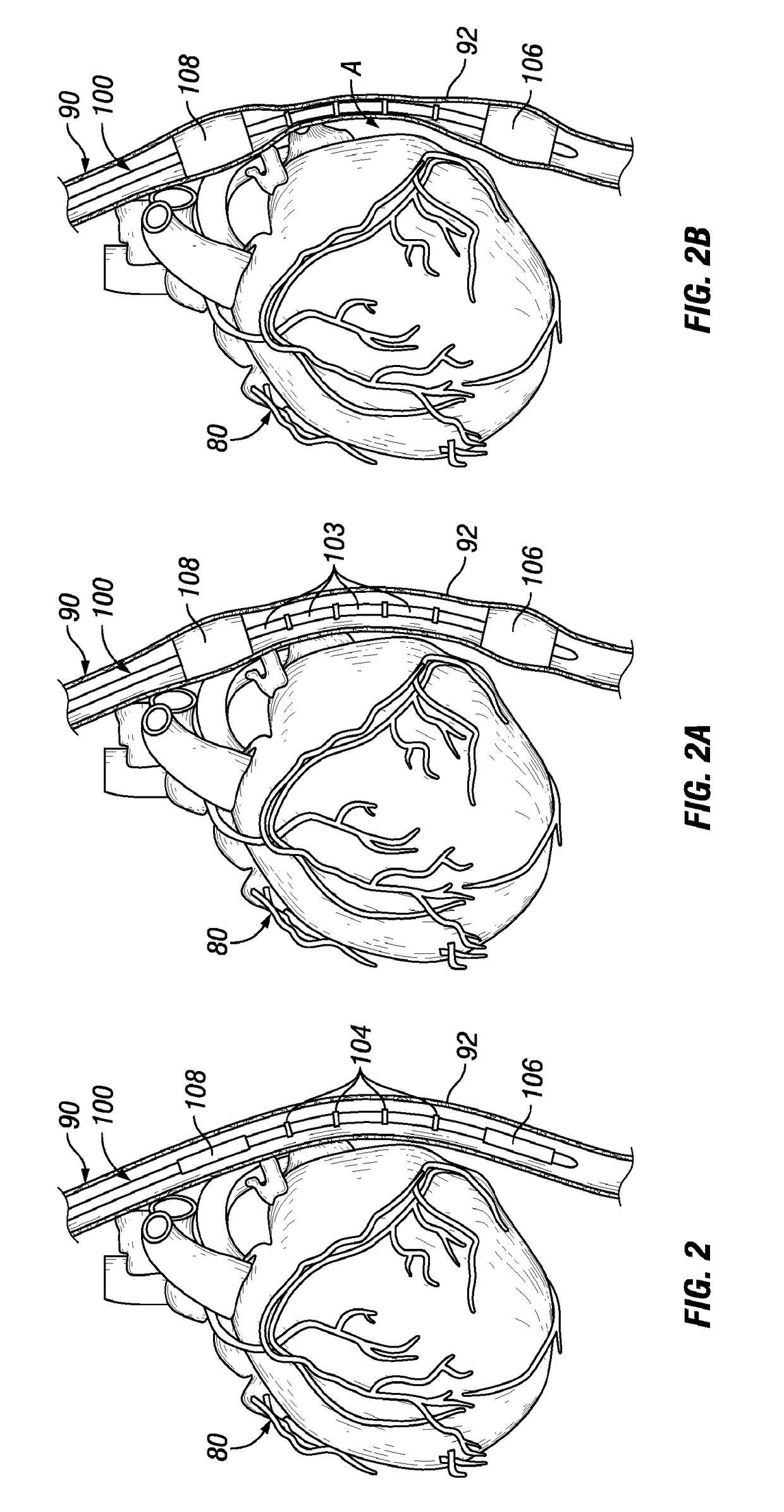 Esophageal Probes and Methods