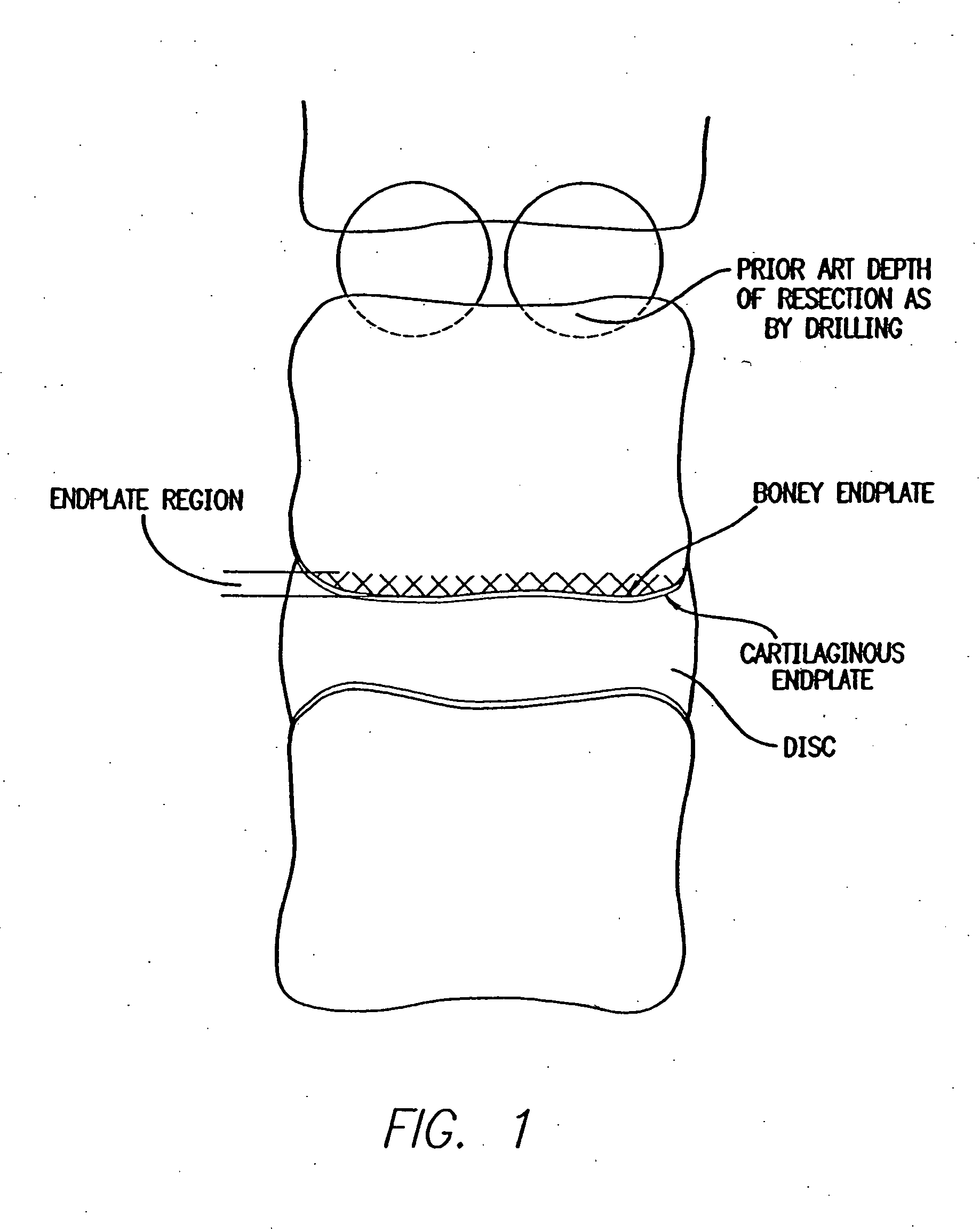 Retractor for percutaneous surgery in a patient and method for use thereof