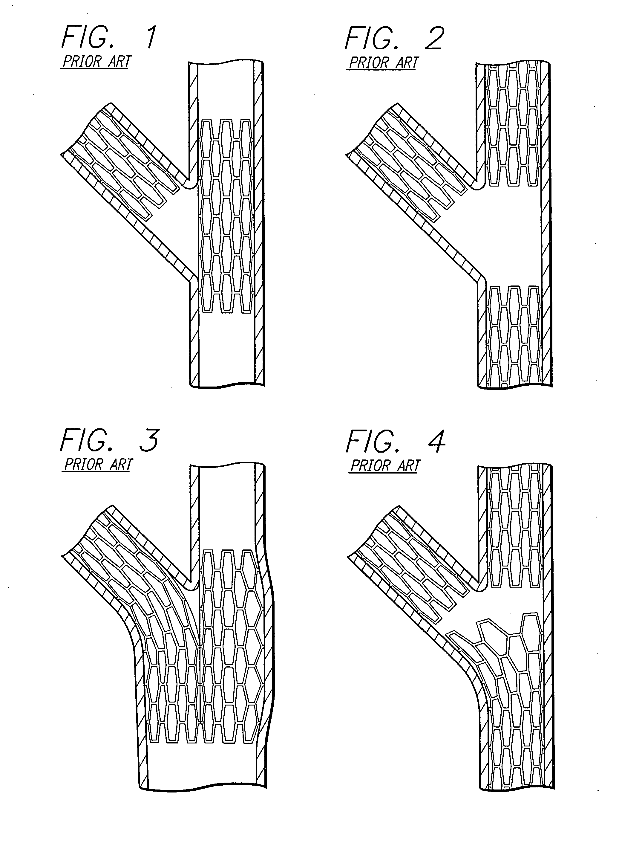 Stent and catheter assembly and method for treating bifurcations