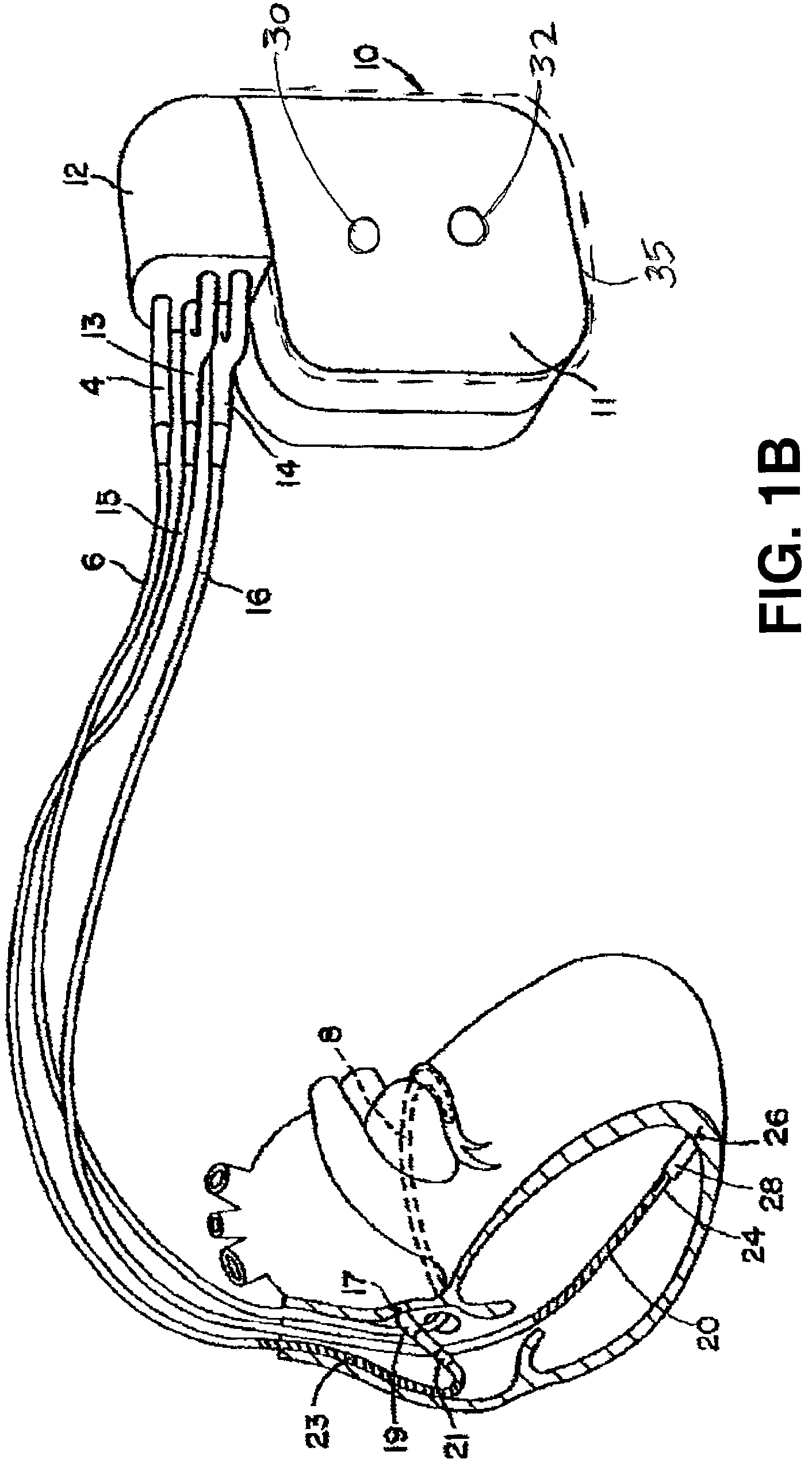 Method for elimination of ventricular pro-arrhythmic effect caused by atrial therapy