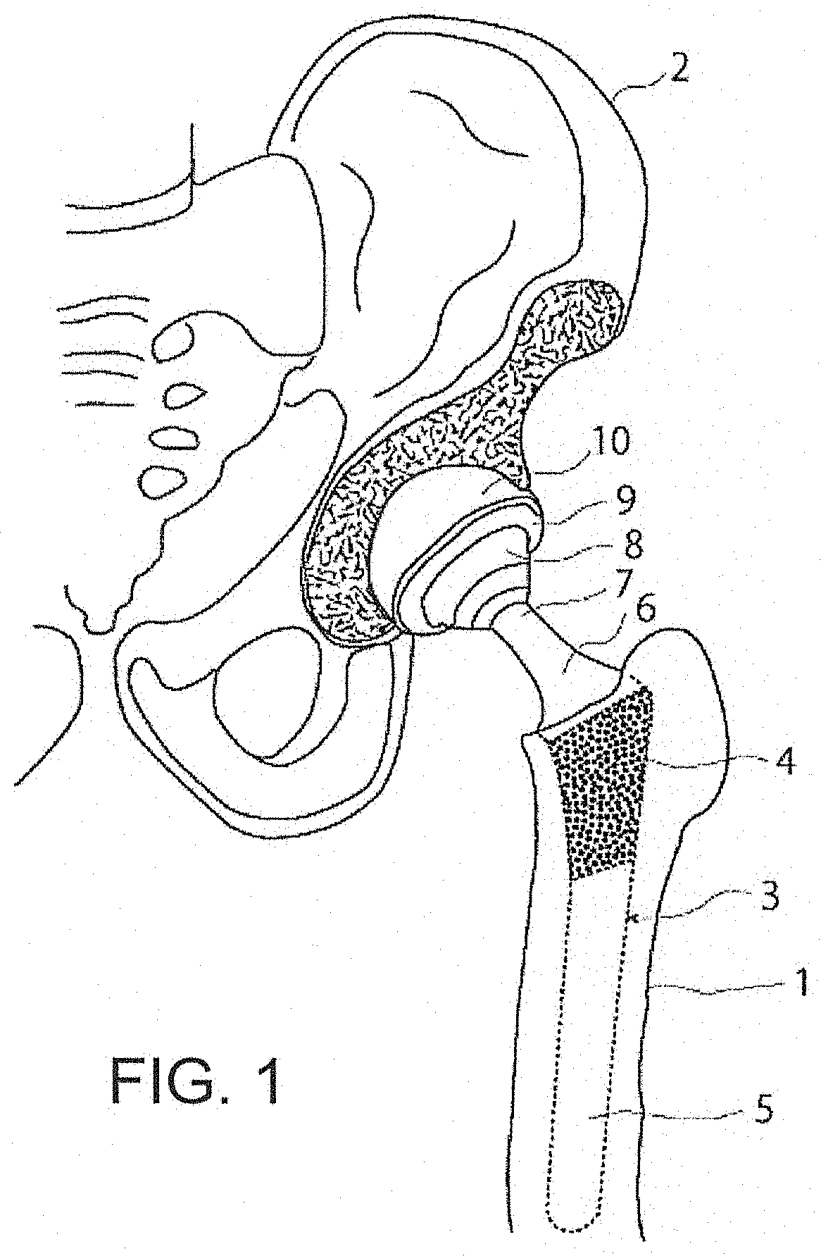 Thin-blade chisel system